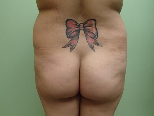 Brazilian Butt Lift (BBL) Before