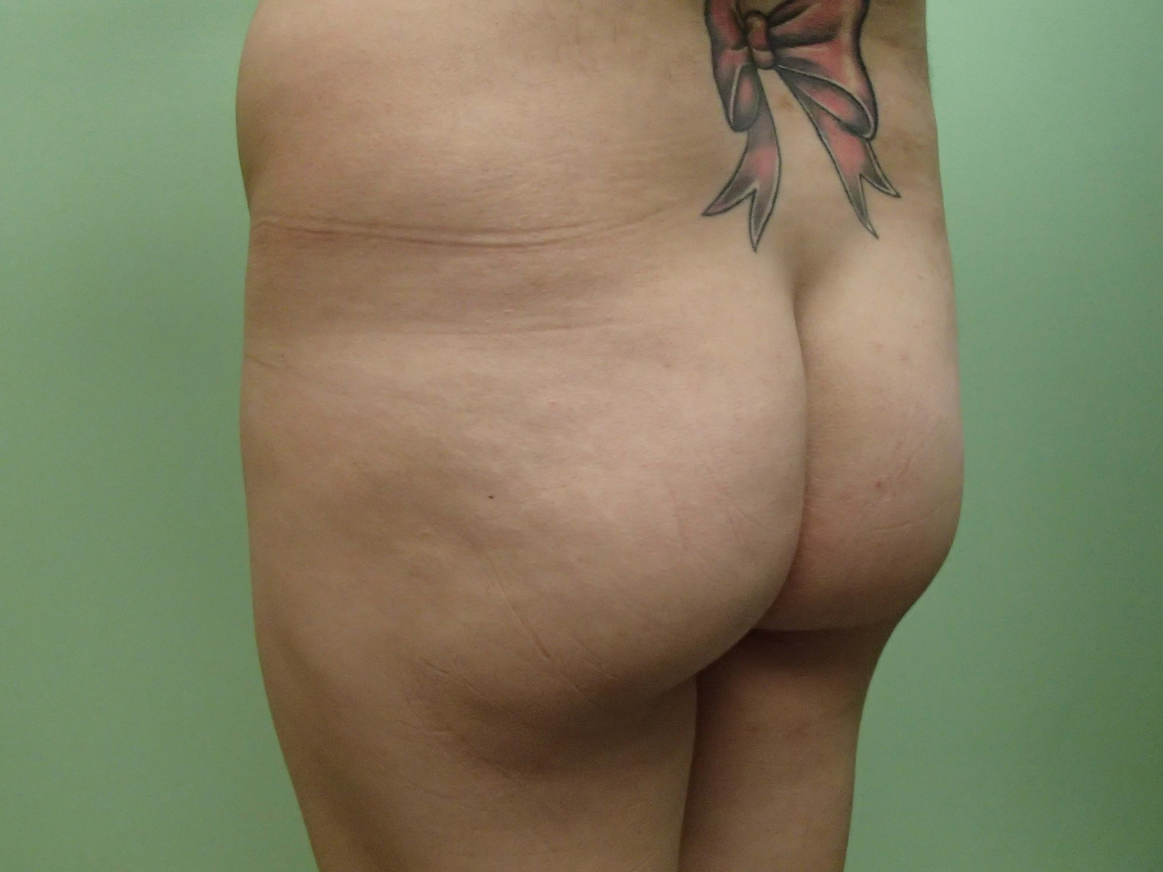 Brazilian Butt Lift (BBL) Before