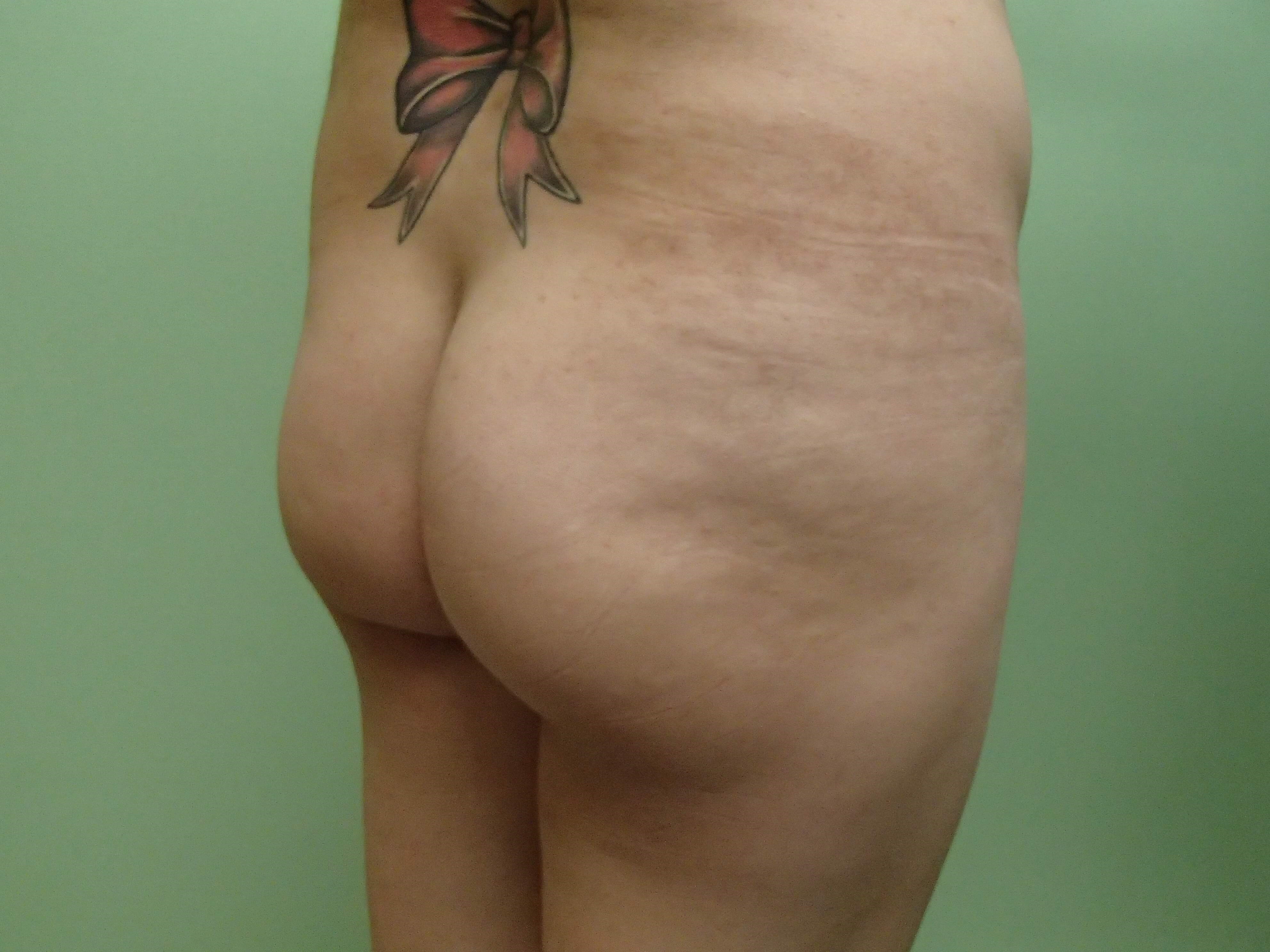 Brazilian Butt Lift (BBL) Before