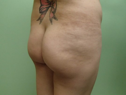 Brazilian Butt Lift (BBL) Before