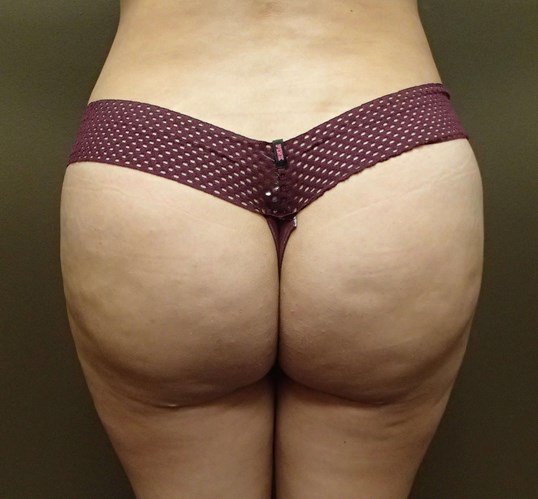 Brazilian Butt Lift (BBL) After