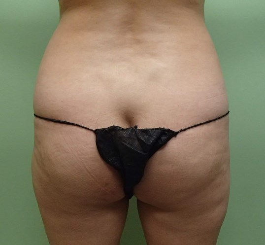 Brazilian Butt Lift (BBL) Before