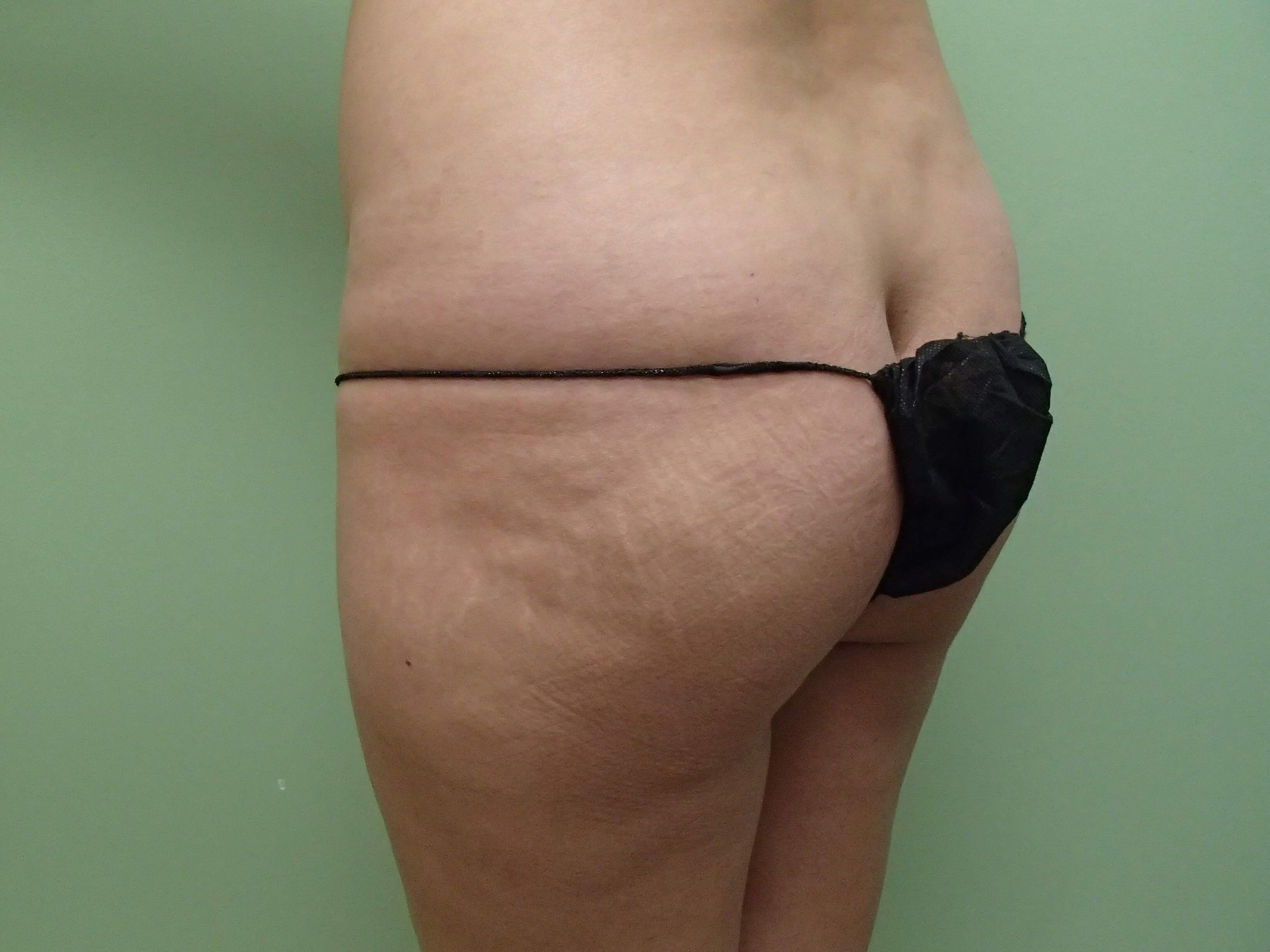 Brazilian Butt Lift (BBL) Before