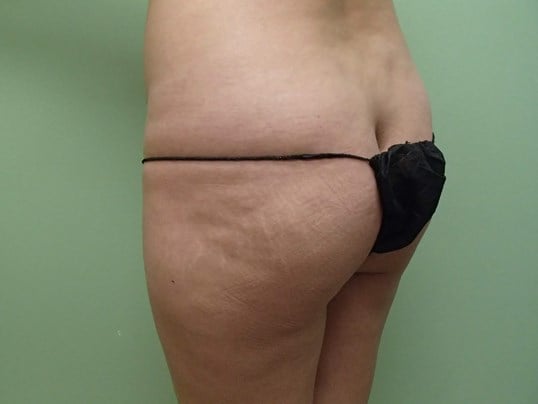 Brazilian Butt Lift (BBL) Before