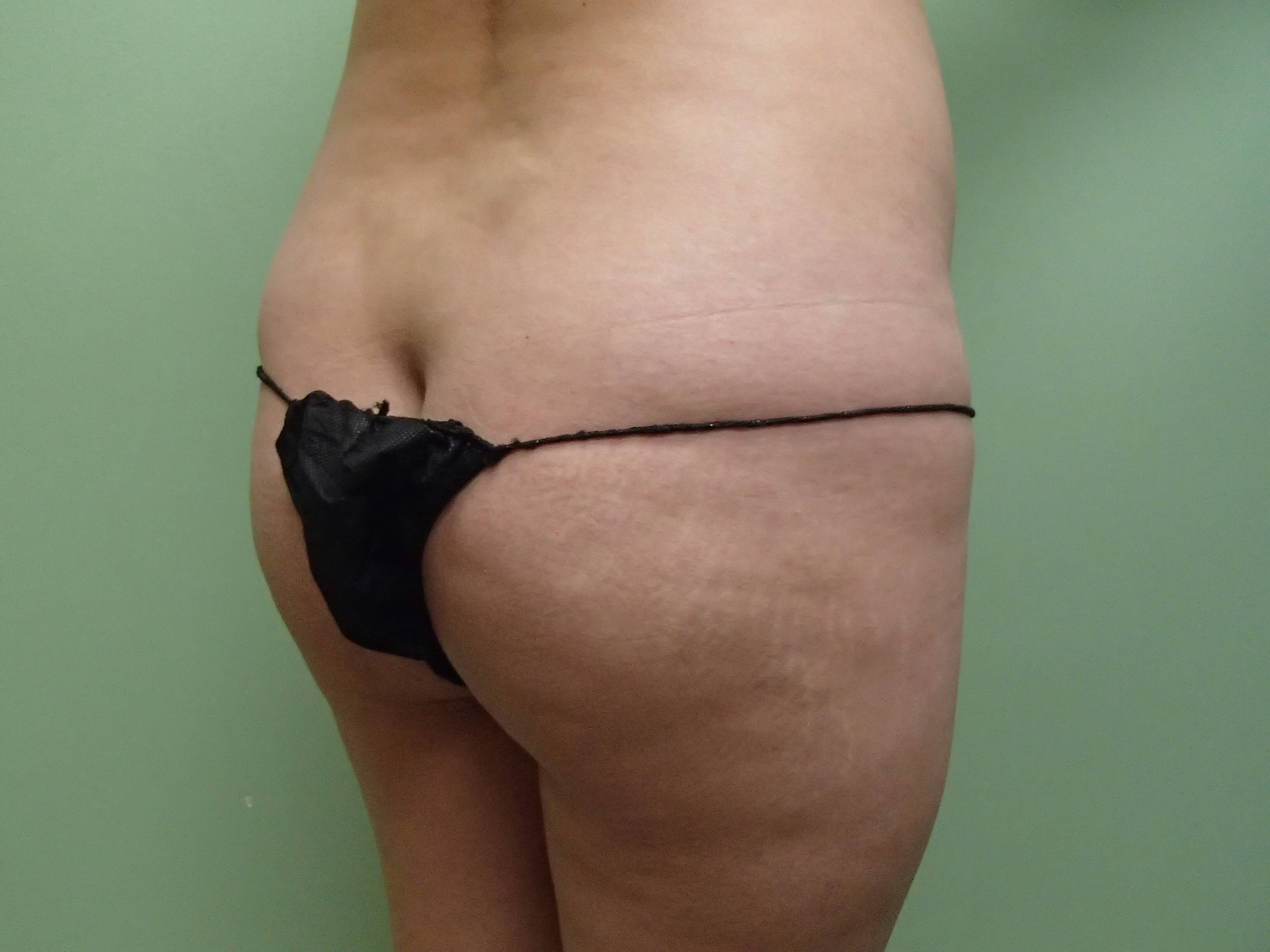 Brazilian Butt Lift (BBL) Before