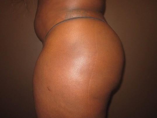 Brazilian Butt Lift (BBL) After