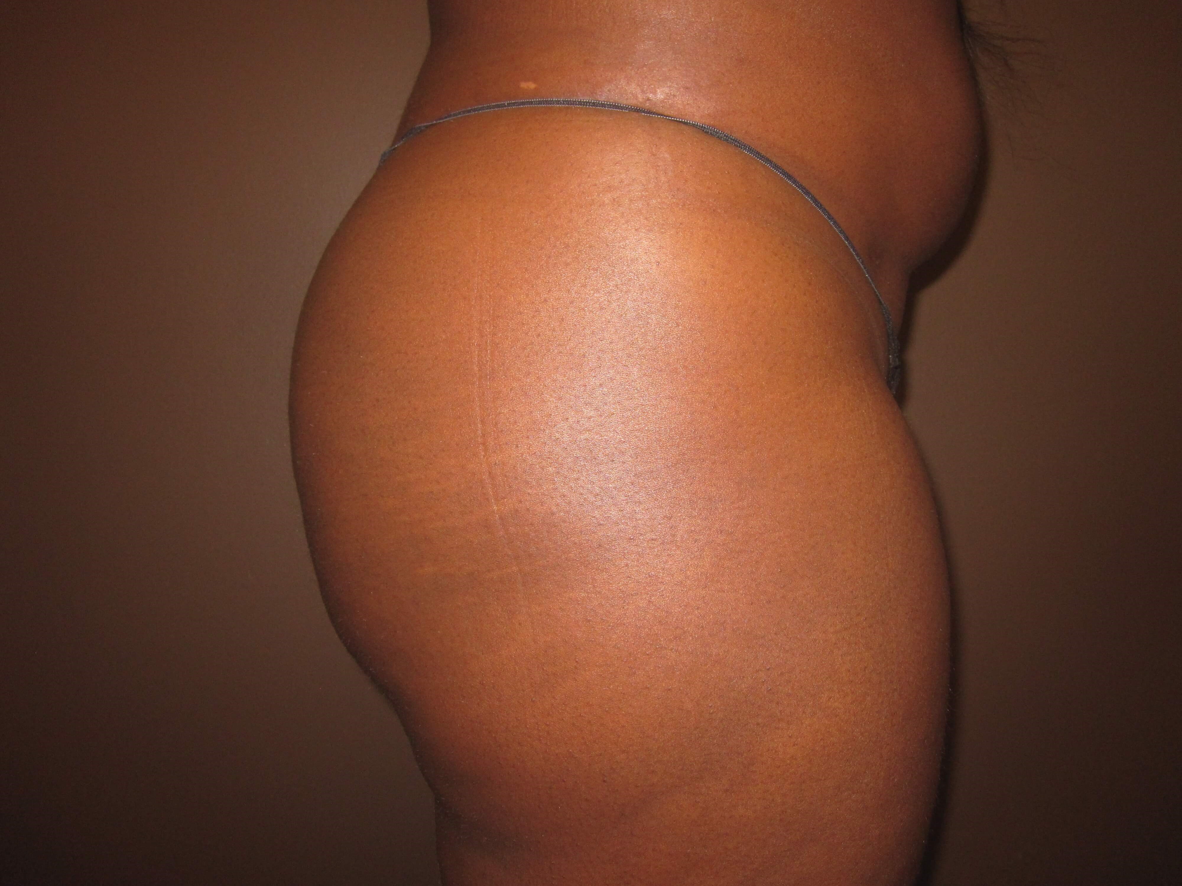 Brazilian Butt Lift (BBL) After