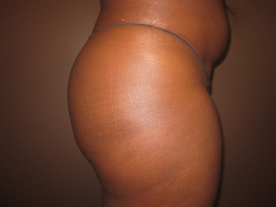 Brazilian Butt Lift (BBL) After