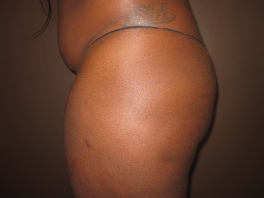 Brazilian Butt Lift (BBL) Before