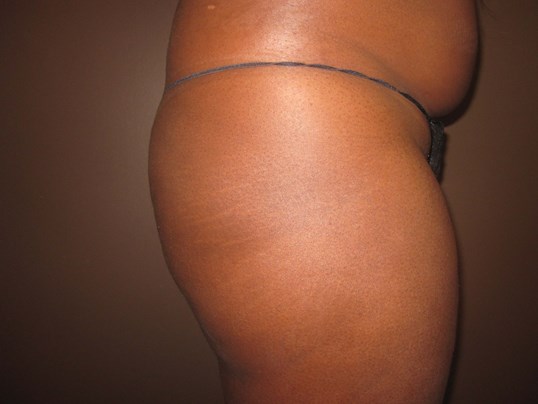 Brazilian Butt Lift (BBL) Before