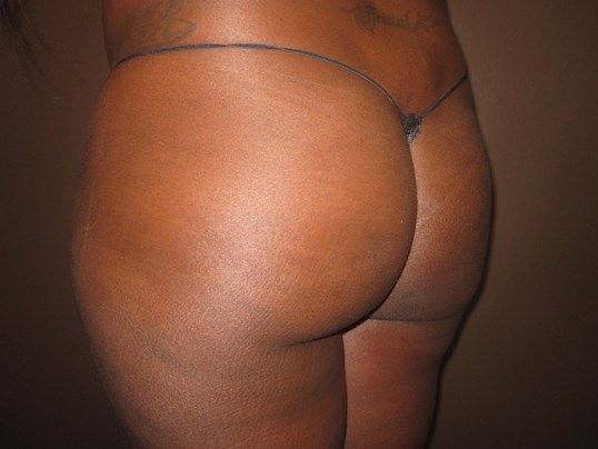Brazilian Butt Lift (BBL) Before