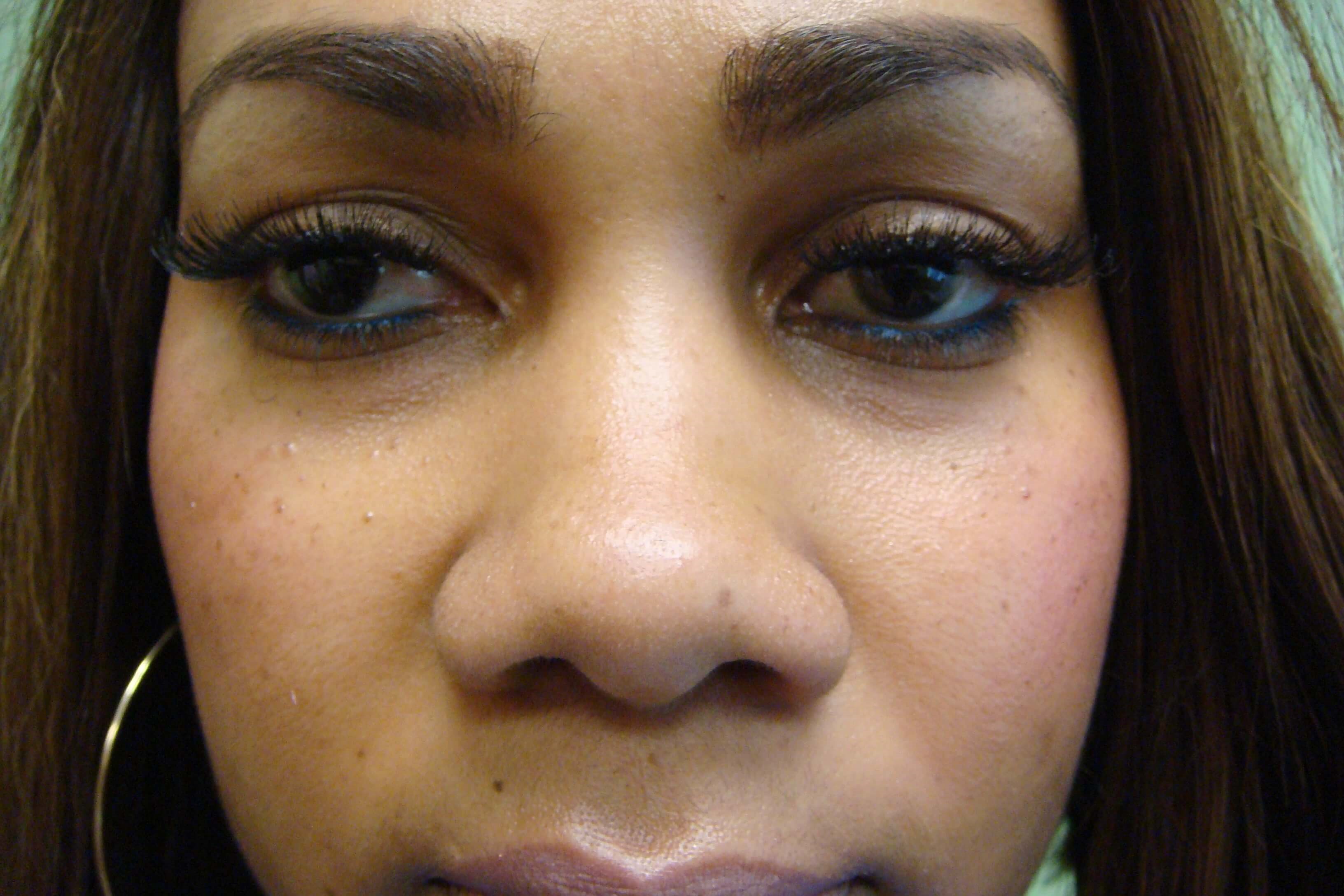 Rhinoplasty with Implant Before