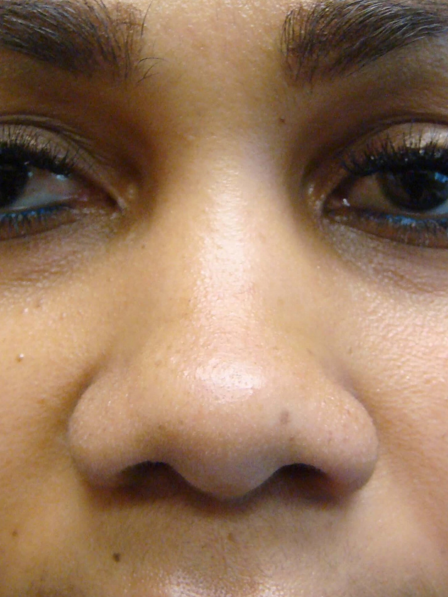 Rhinoplasty with Implant Before