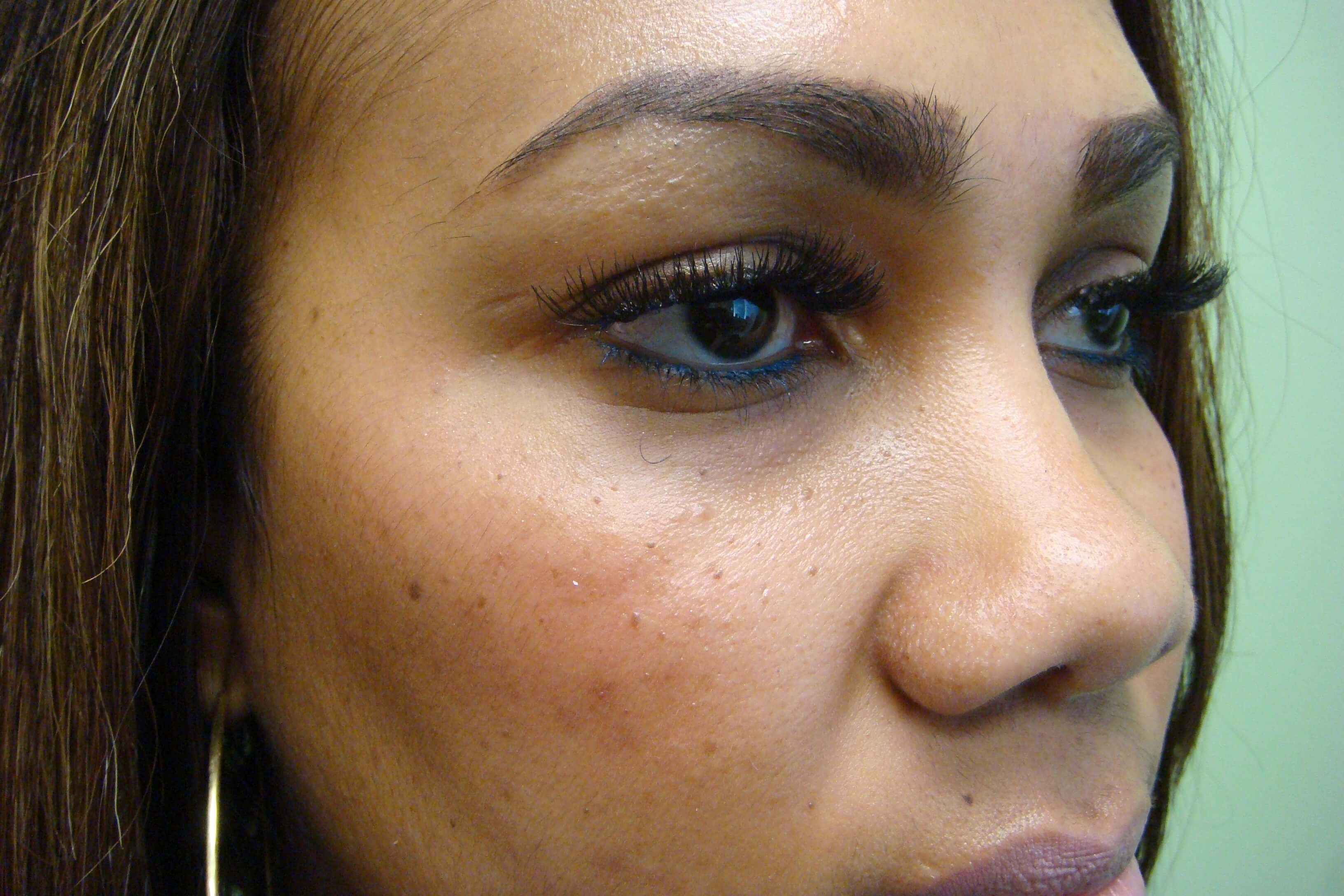 Rhinoplasty with Implant Before