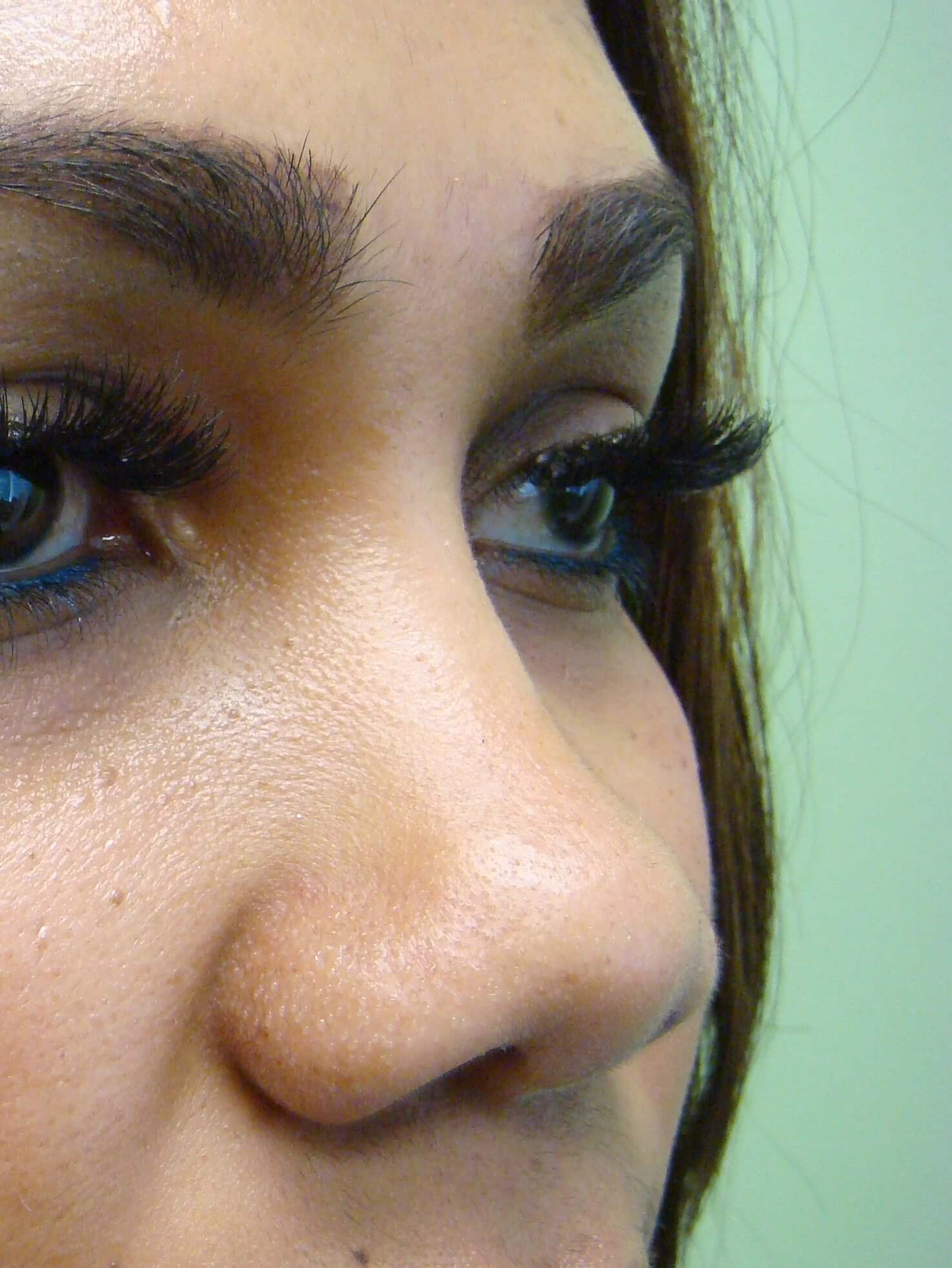 Rhinoplasty with Implant Before
