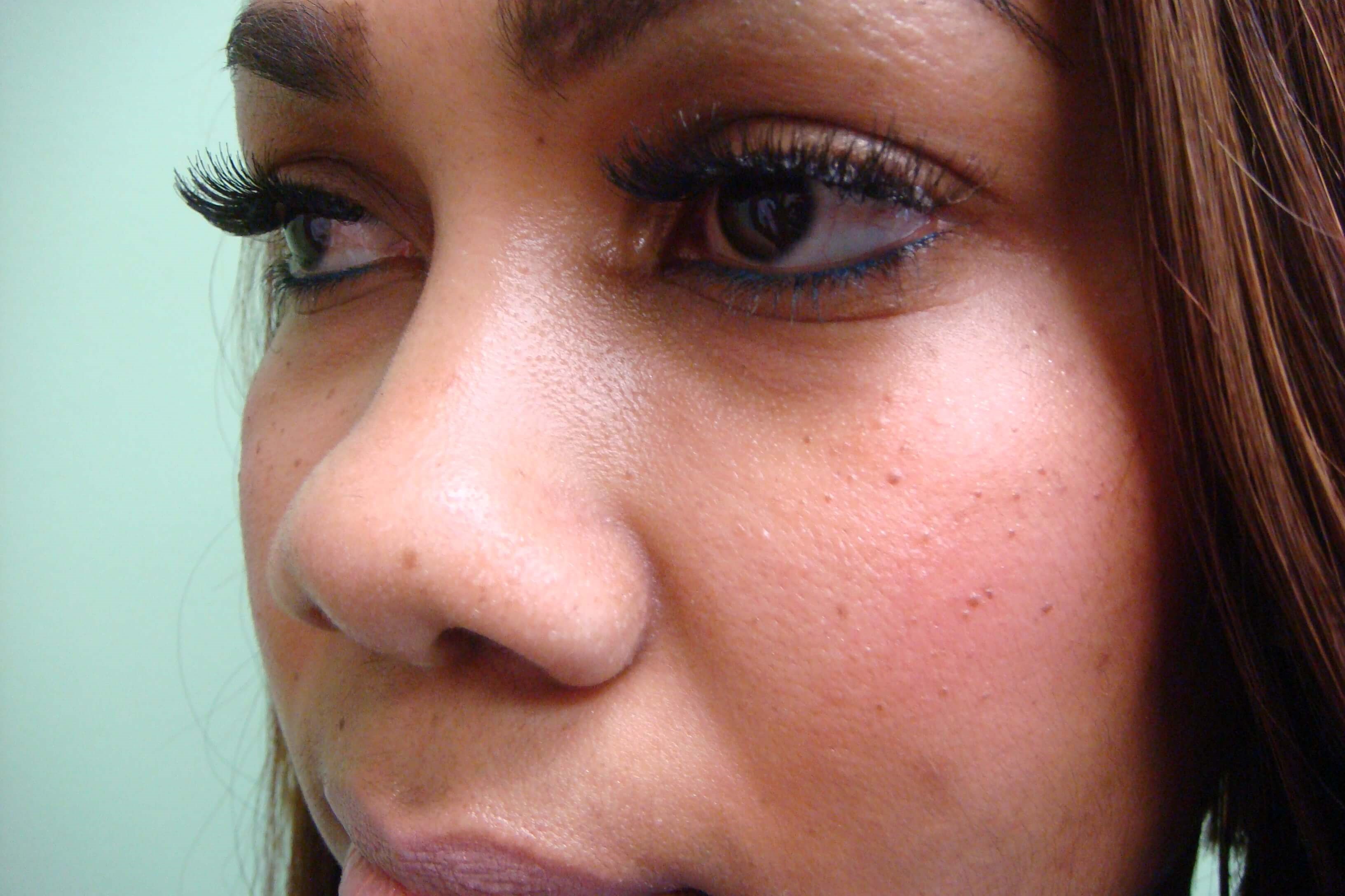 Rhinoplasty with Implant Before