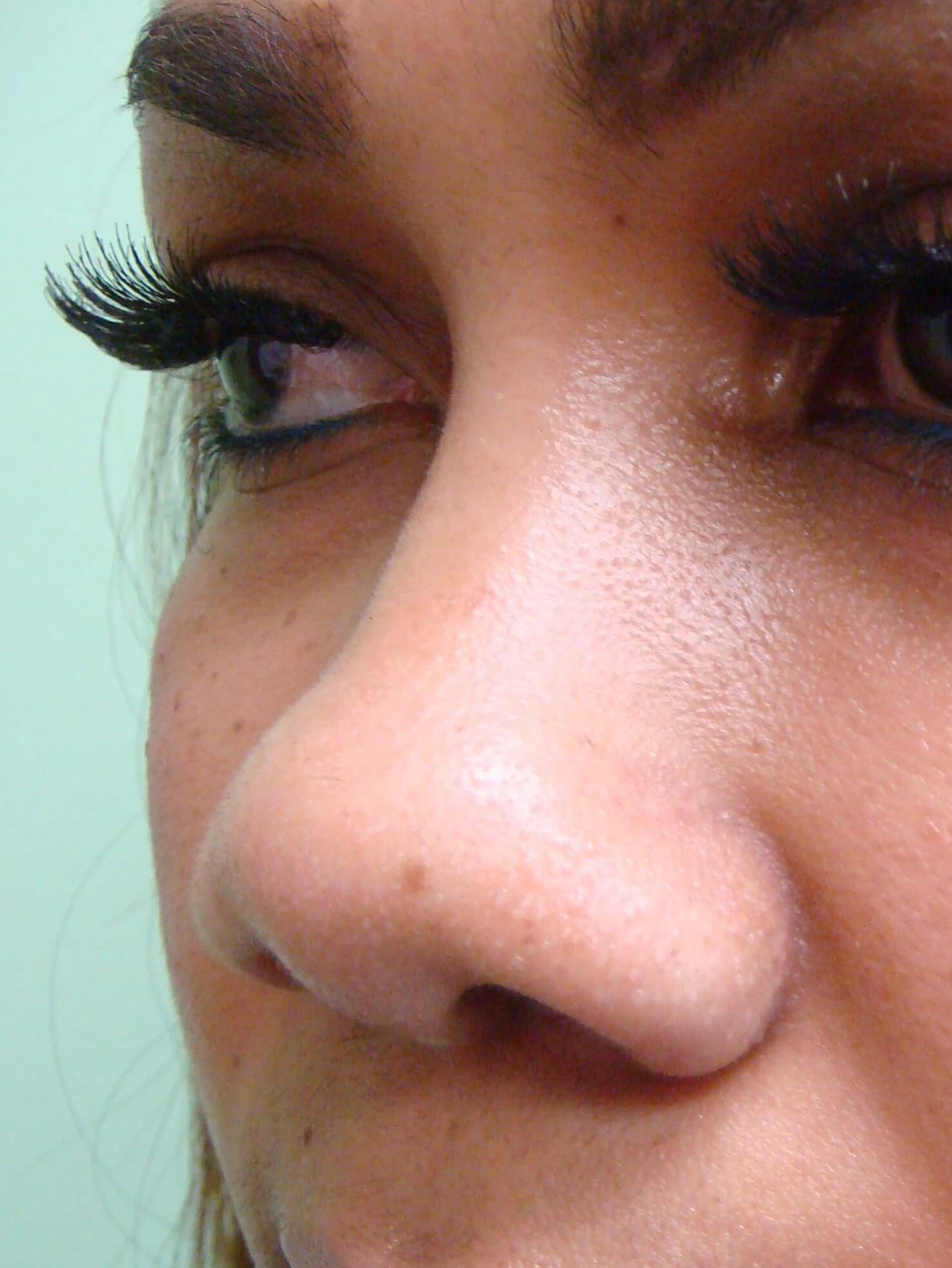 Rhinoplasty with Implant Before