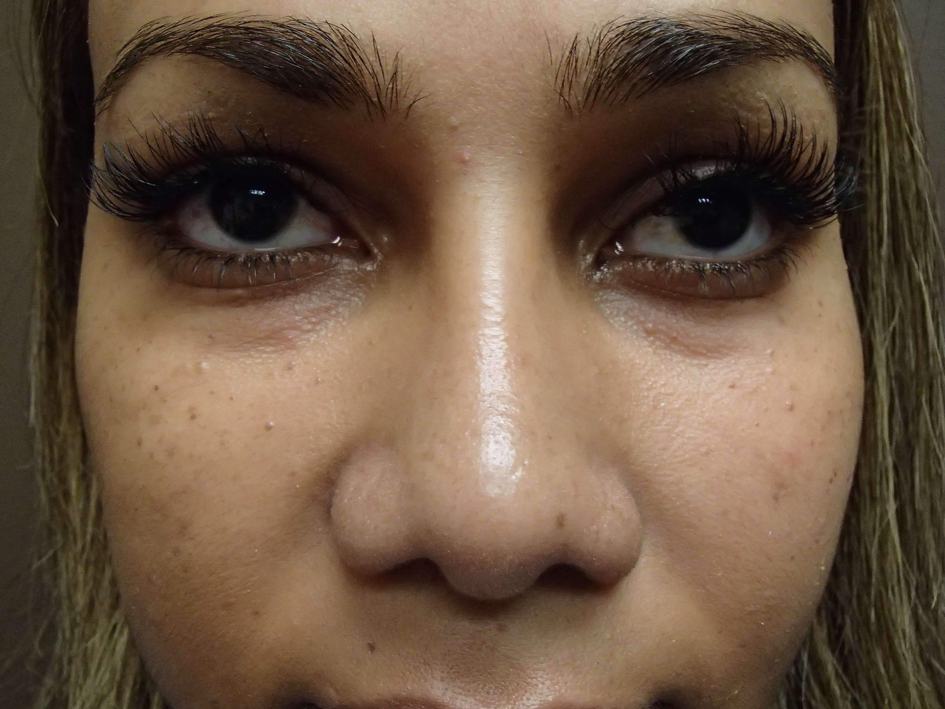 Rhinoplasty with Implant After