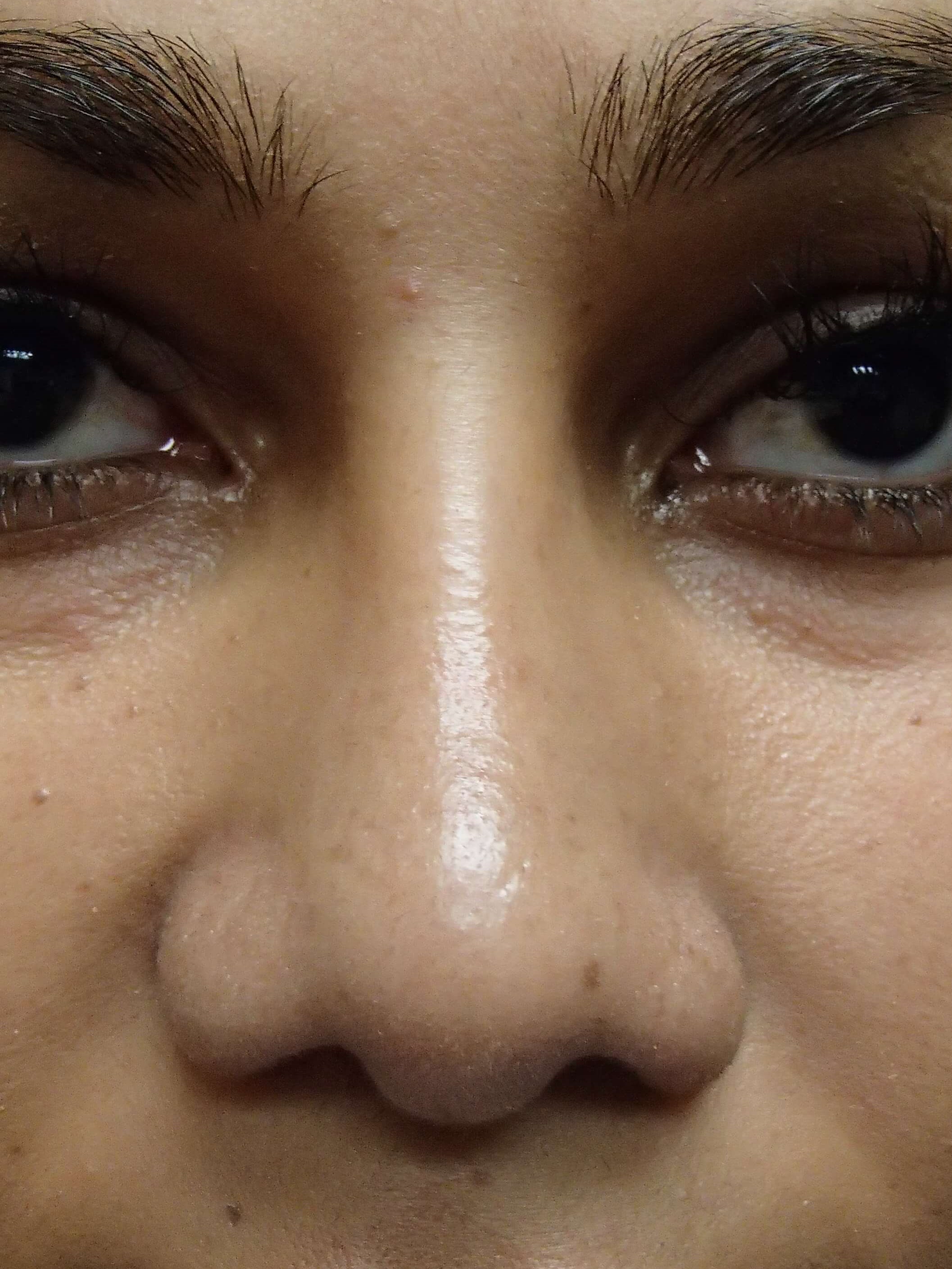 Rhinoplasty with Implant After