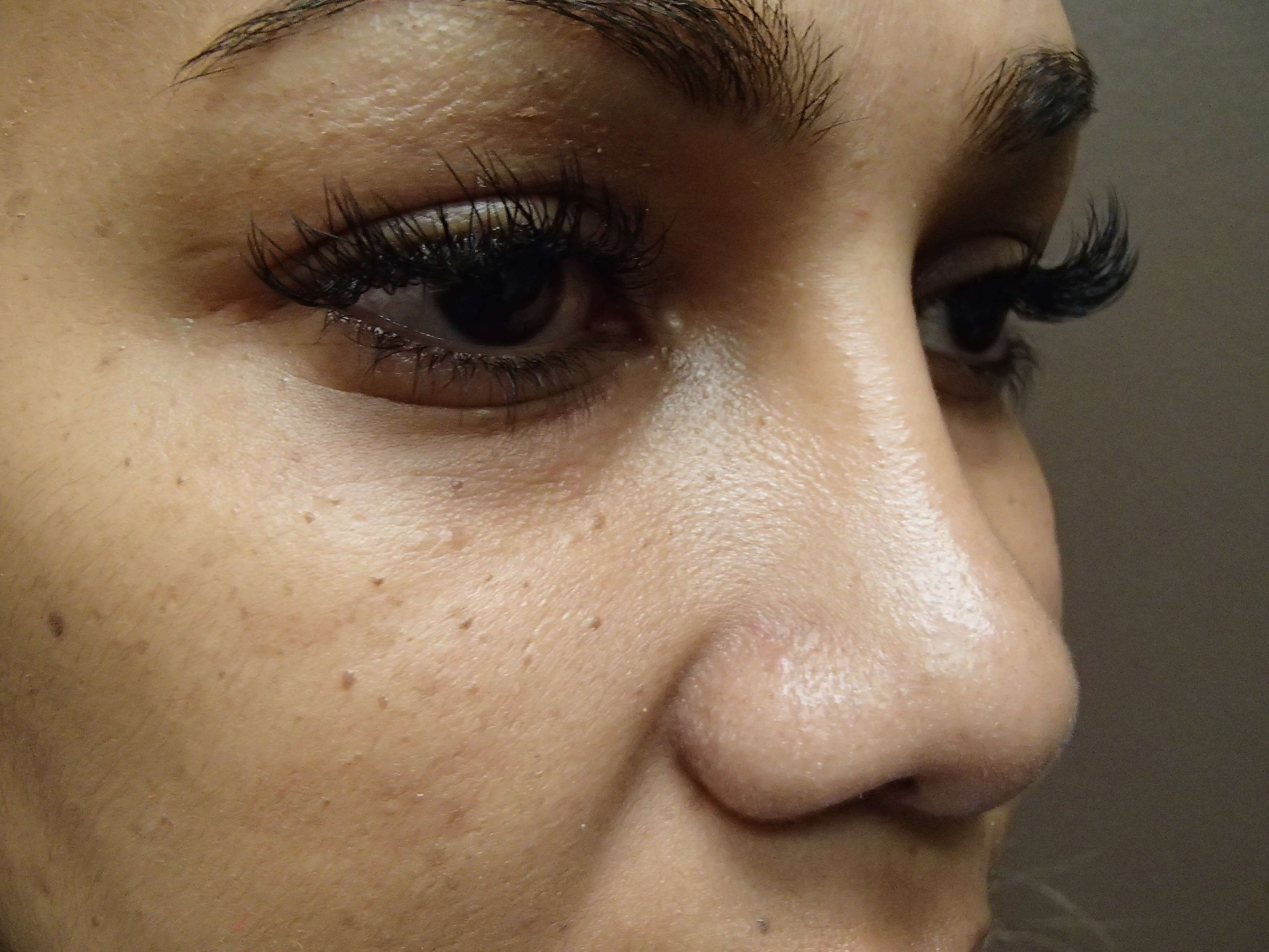 Rhinoplasty with Implant After