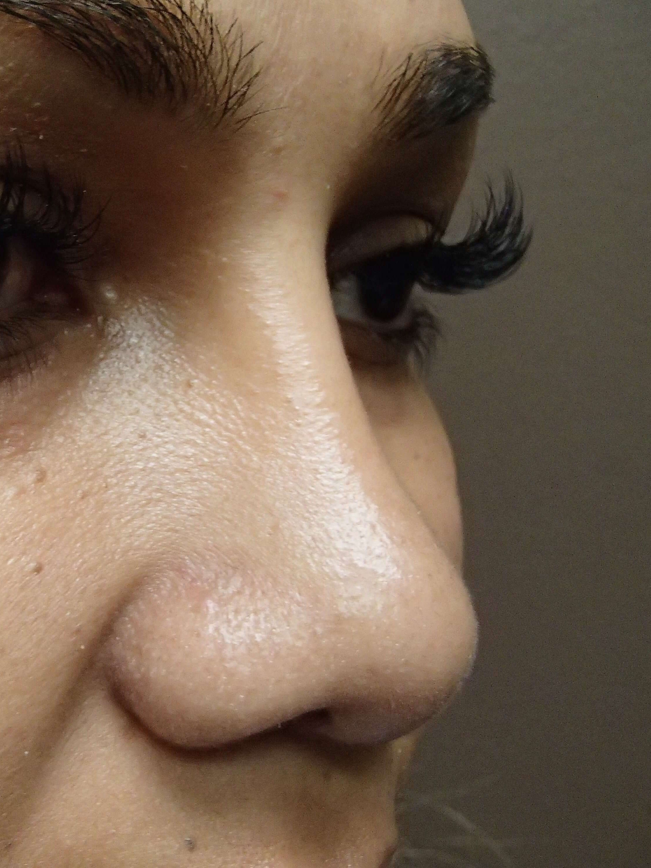 Rhinoplasty with Implant After