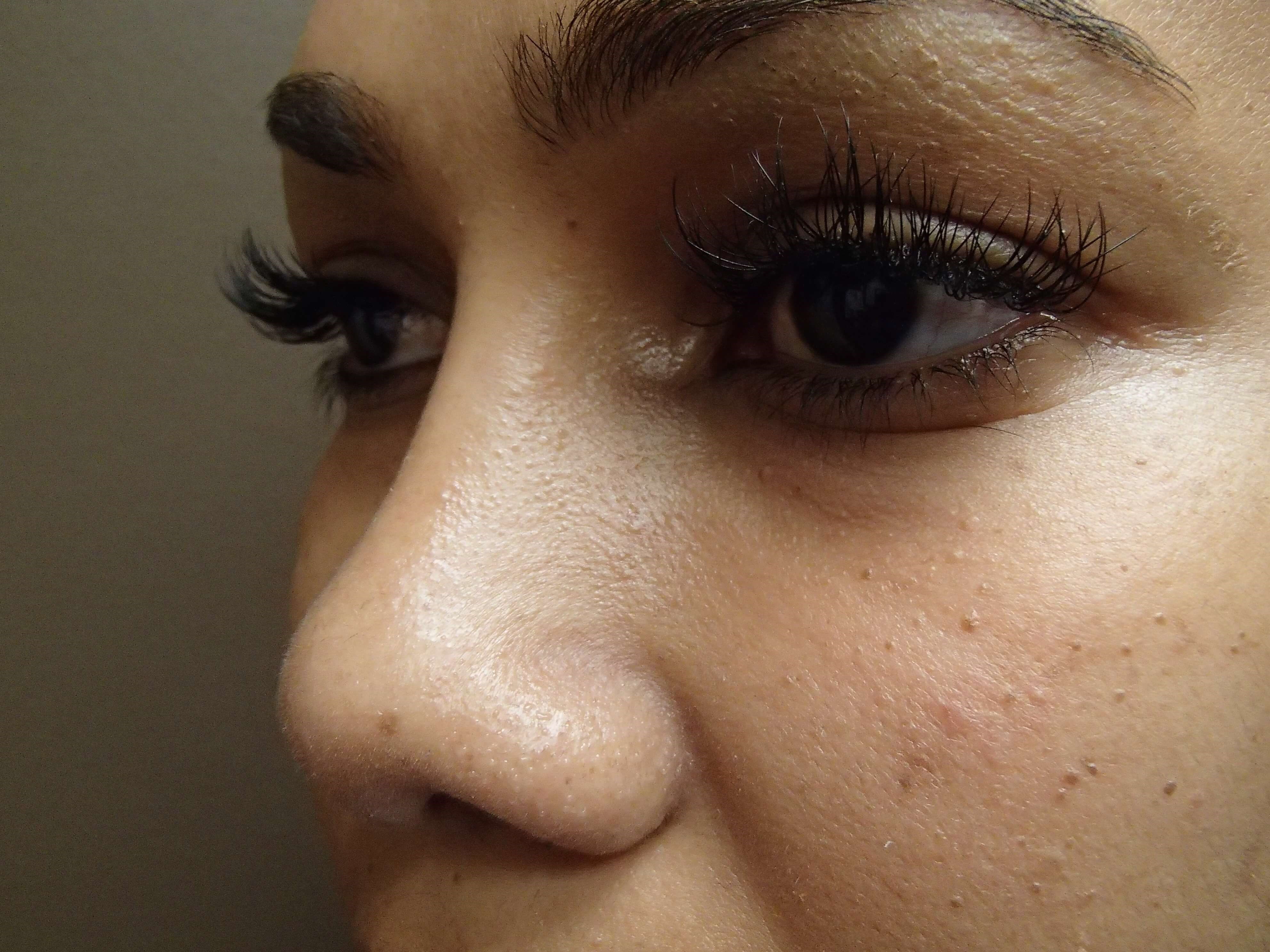 Rhinoplasty with Implant After