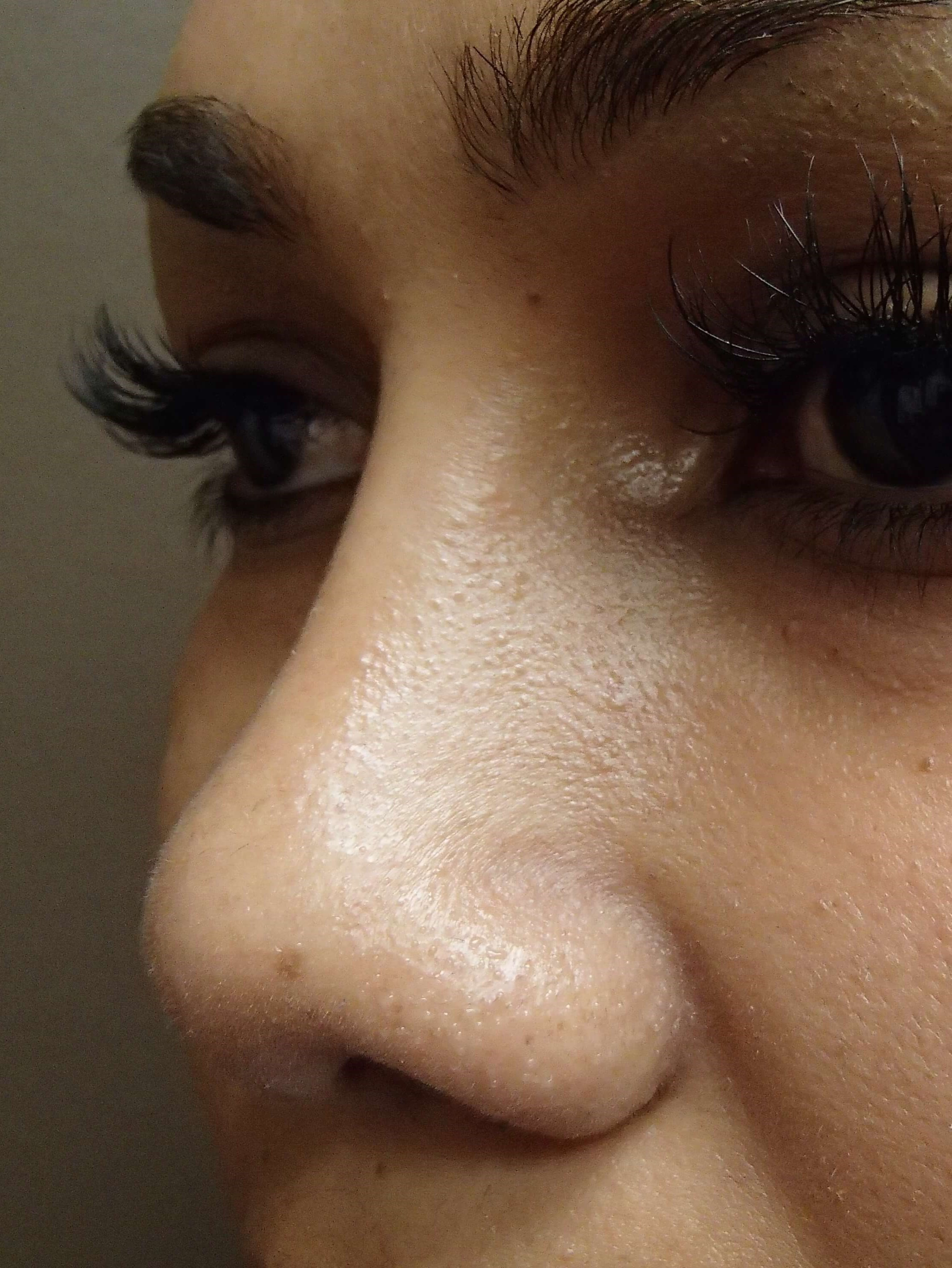 Rhinoplasty with Implant After