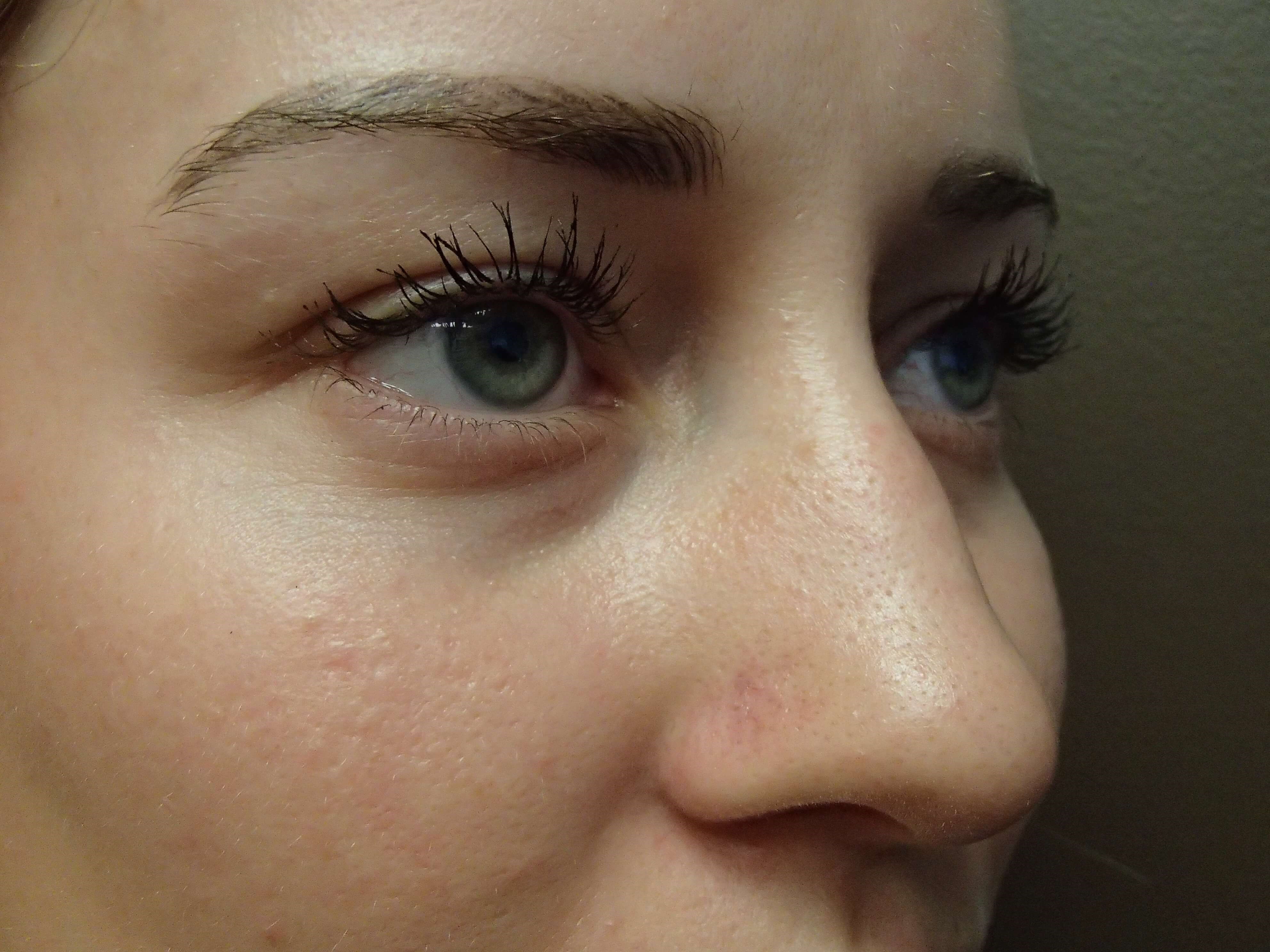 Rhinoplasty (nose job) Before