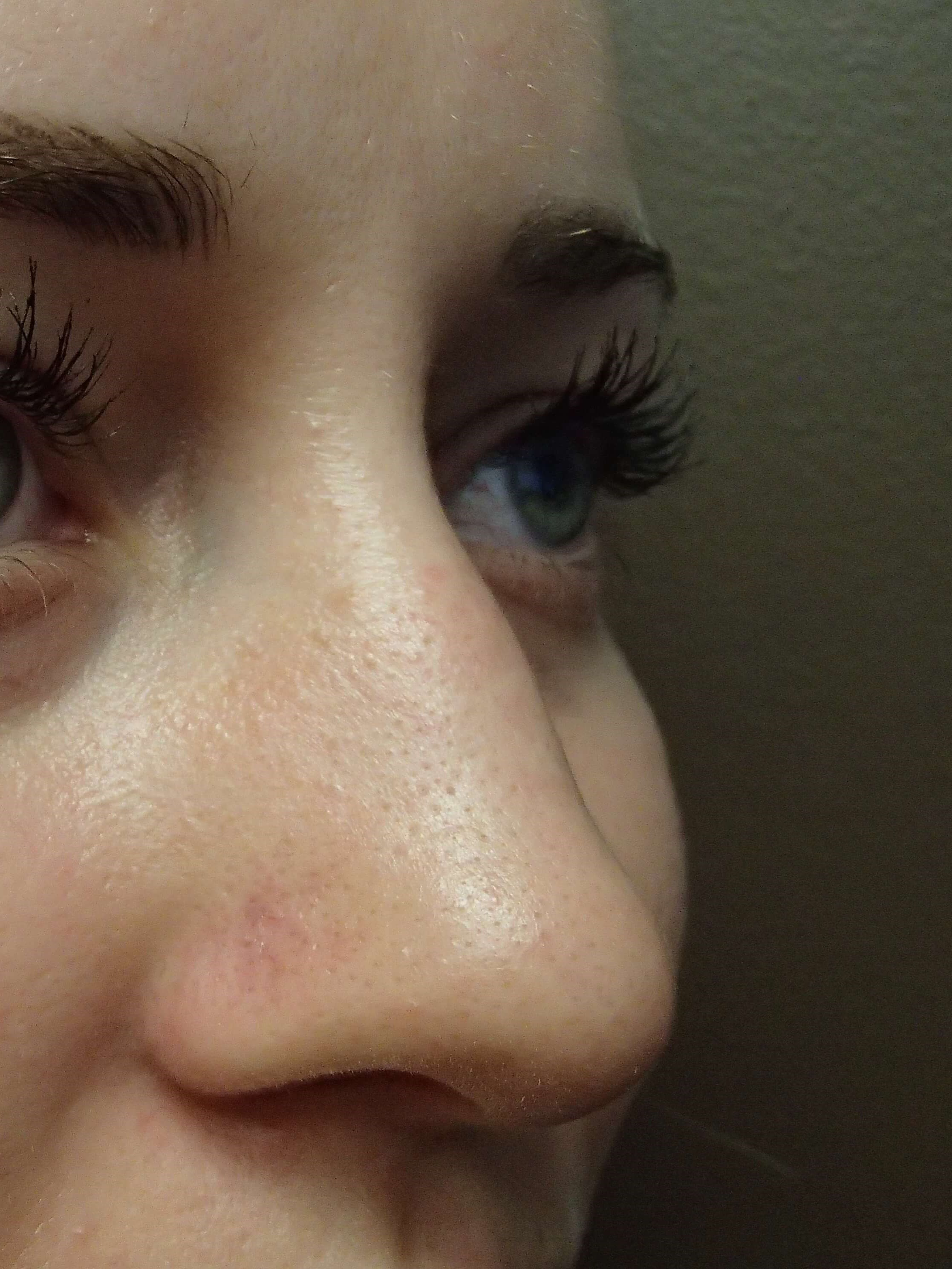 Rhinoplasty (nose job) Before