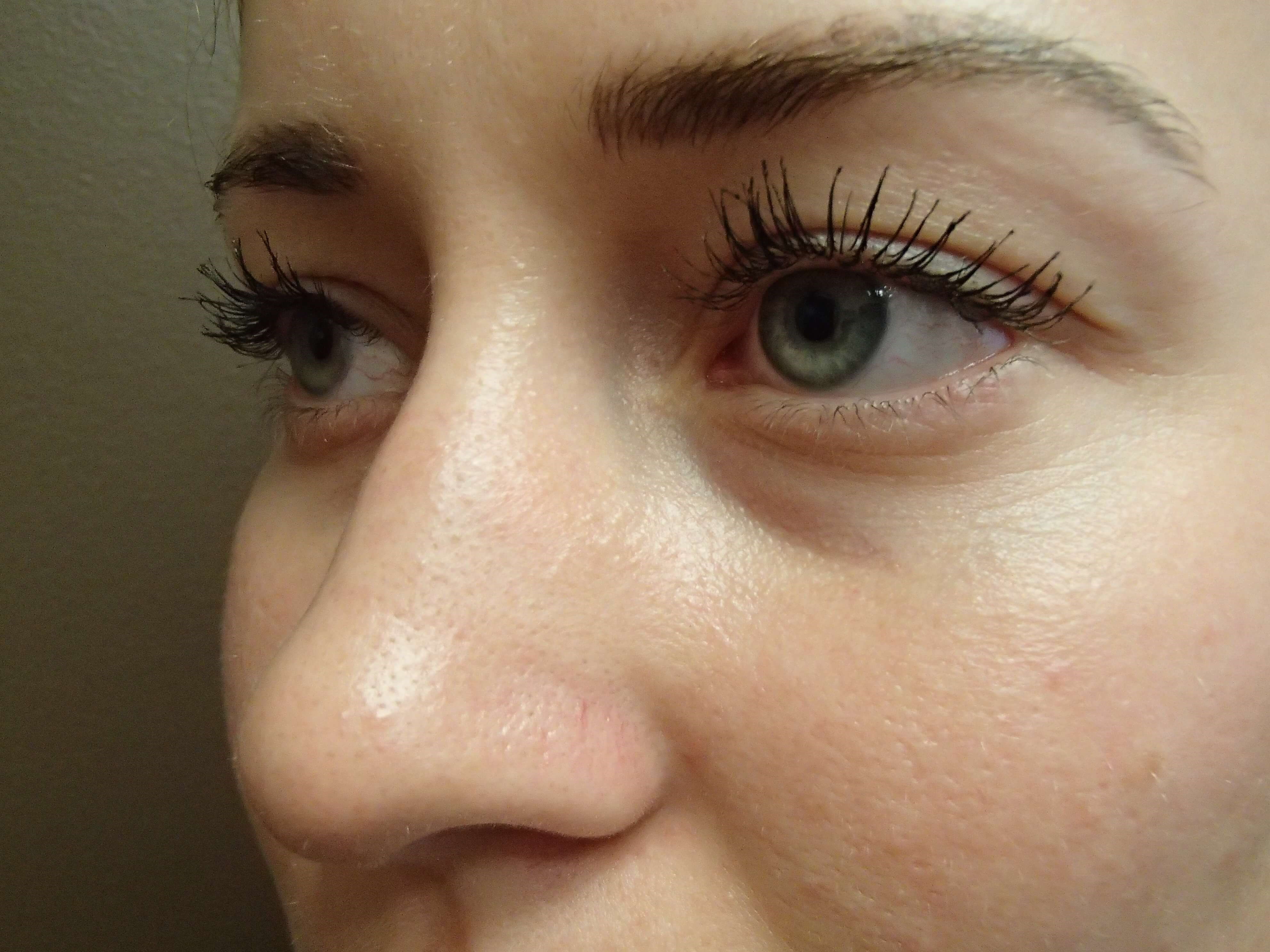 Rhinoplasty (nose job) Before