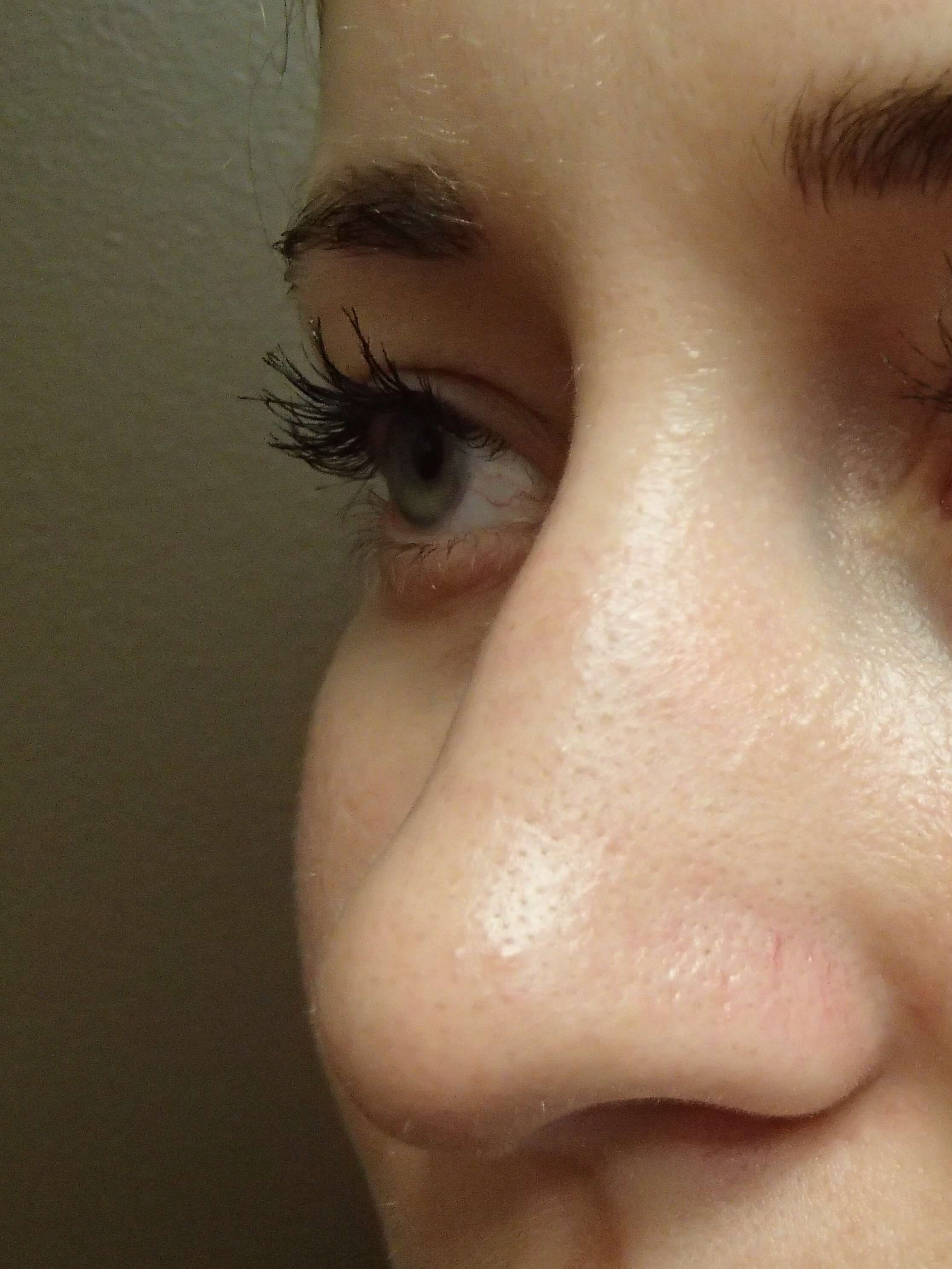Rhinoplasty (nose job) Before