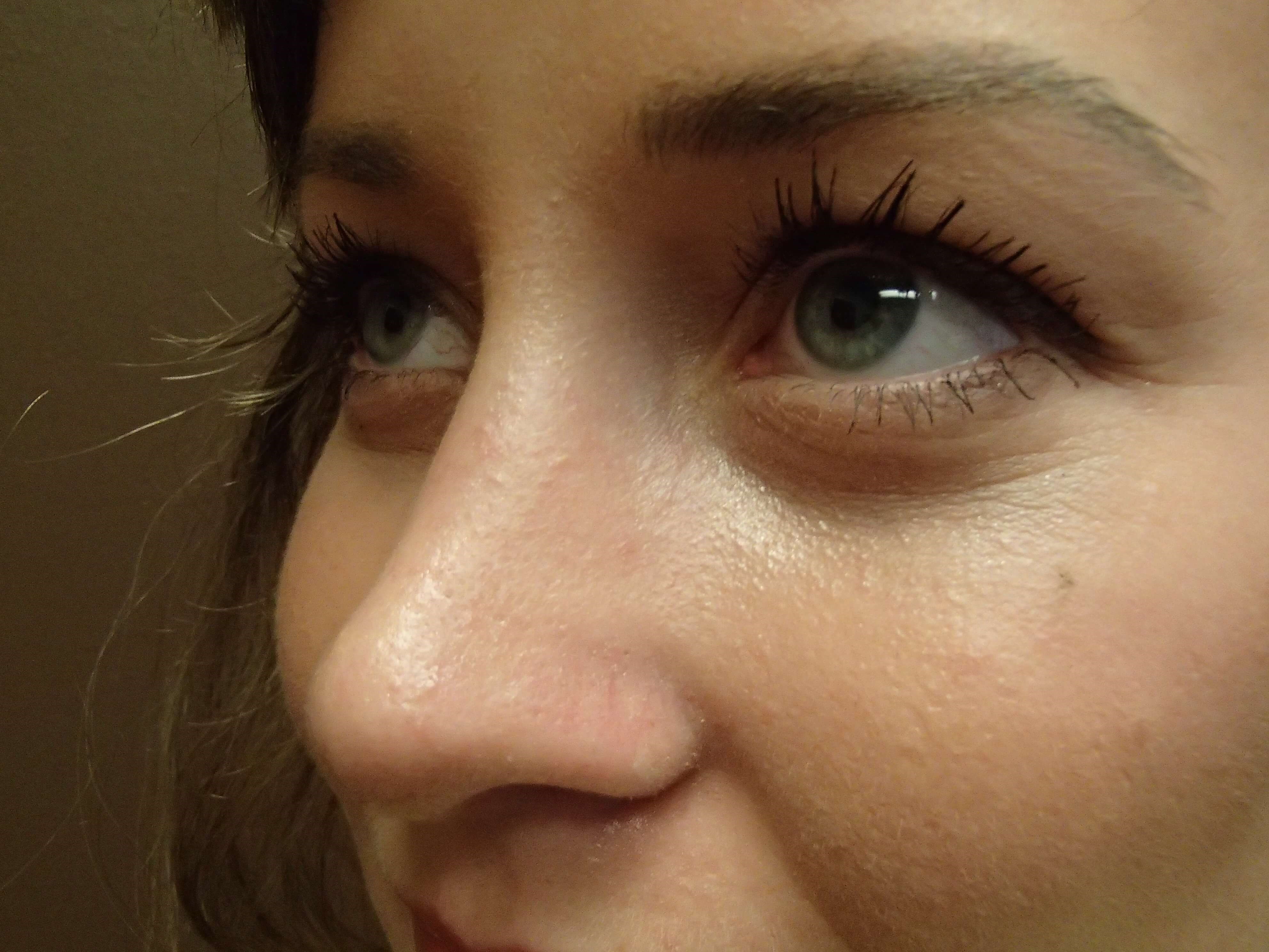 Rhinoplasty (nose job) After