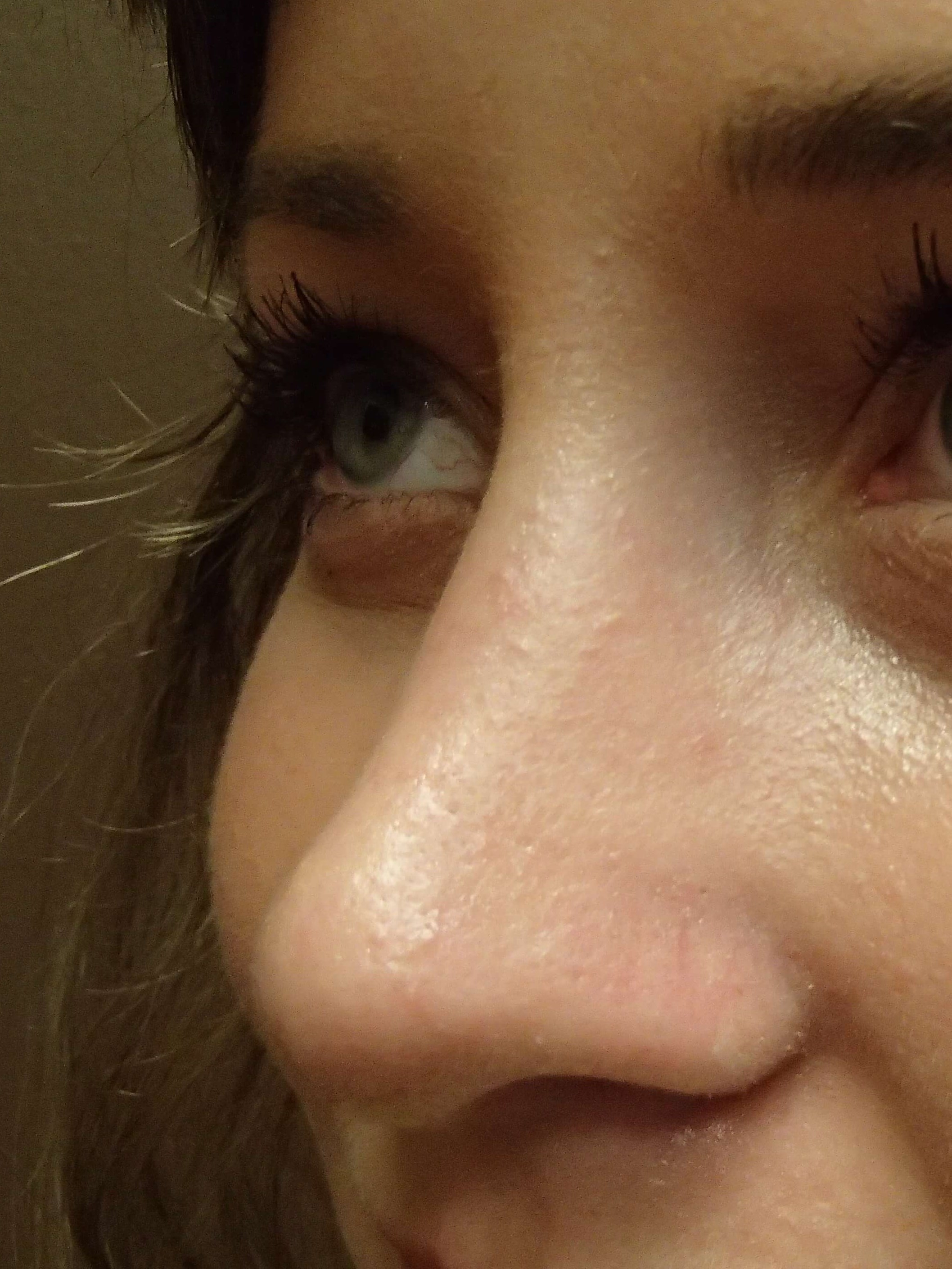 Rhinoplasty (nose job) After