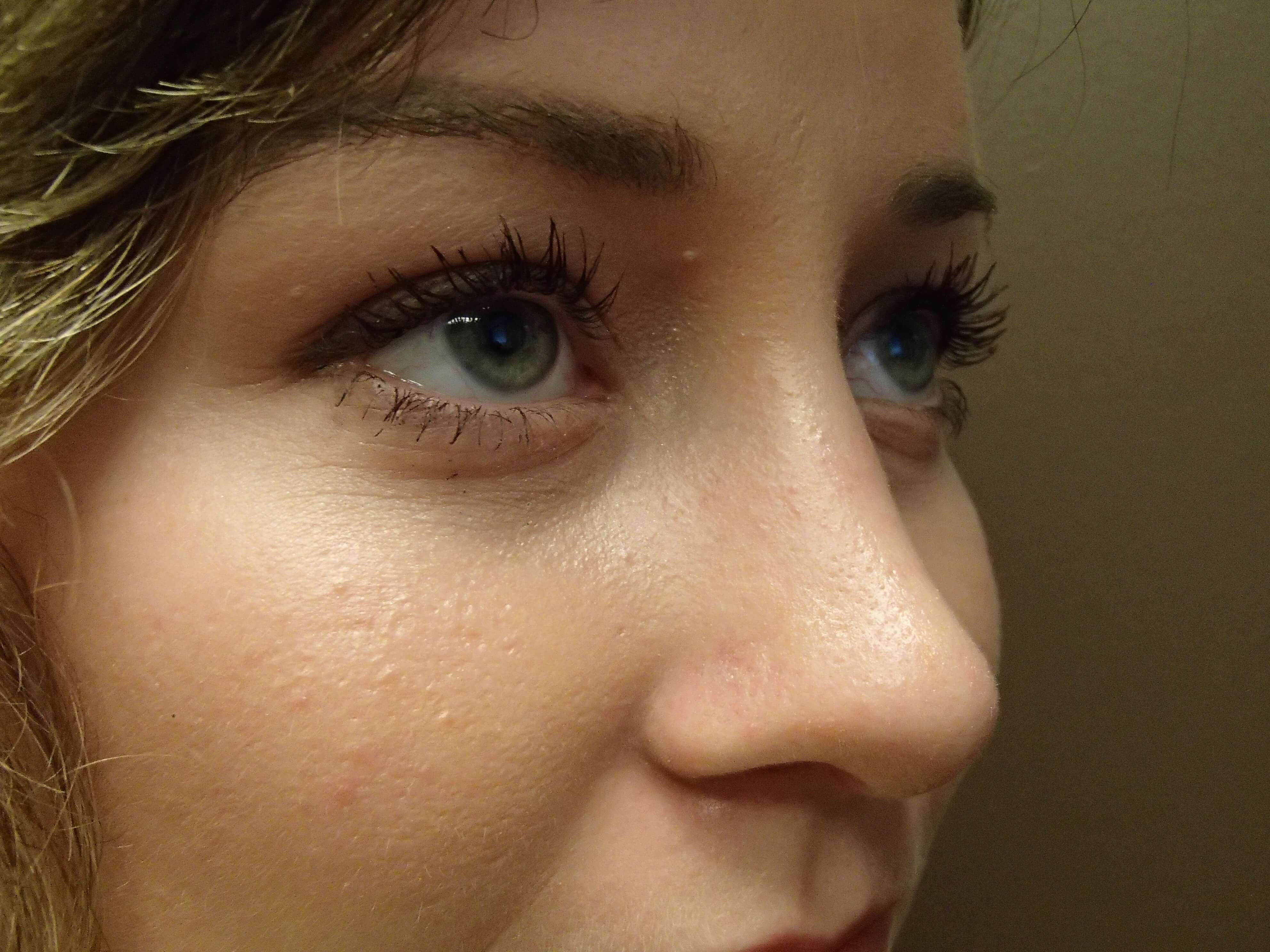Rhinoplasty (nose job) After