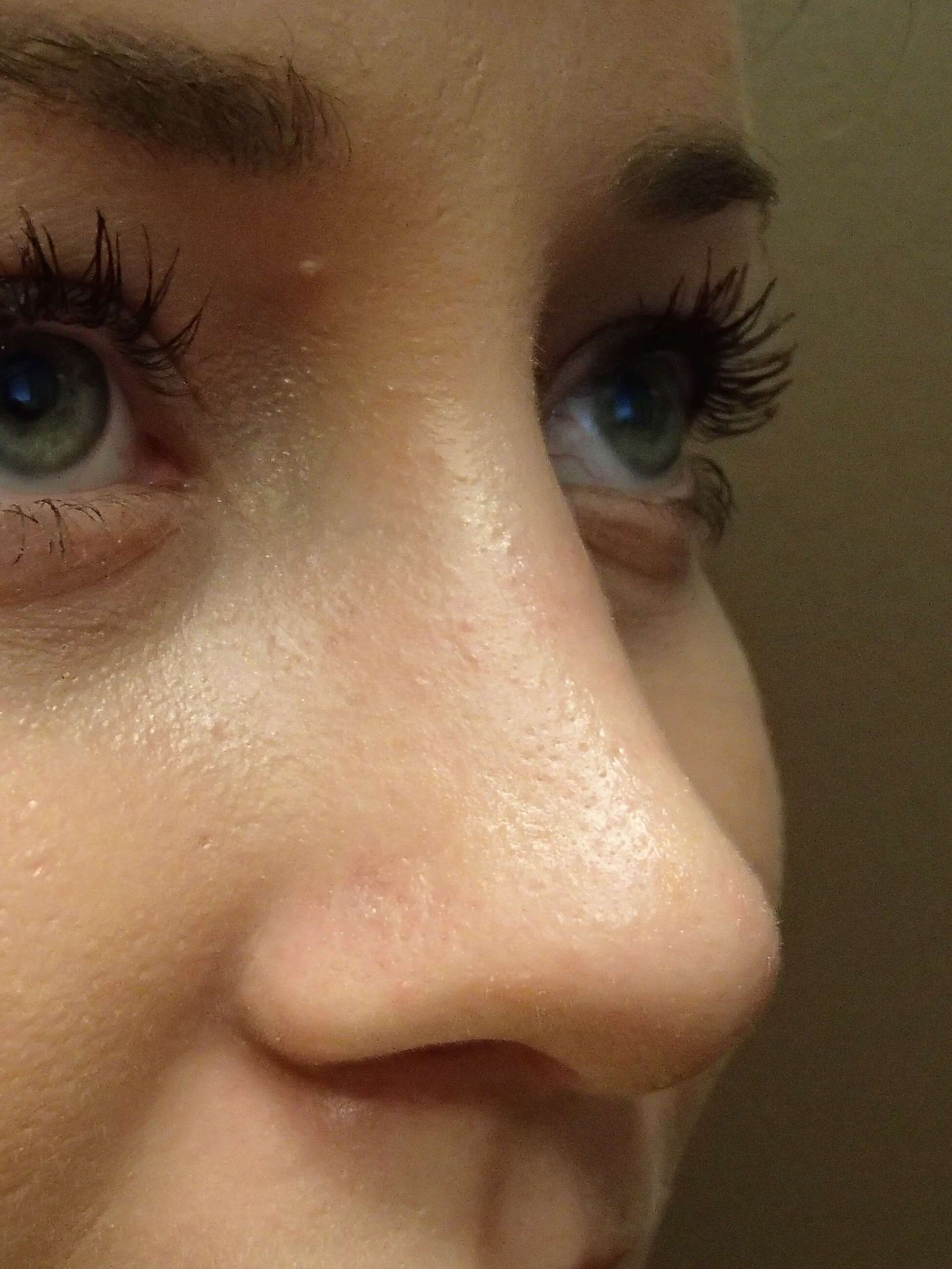Rhinoplasty (nose job) After