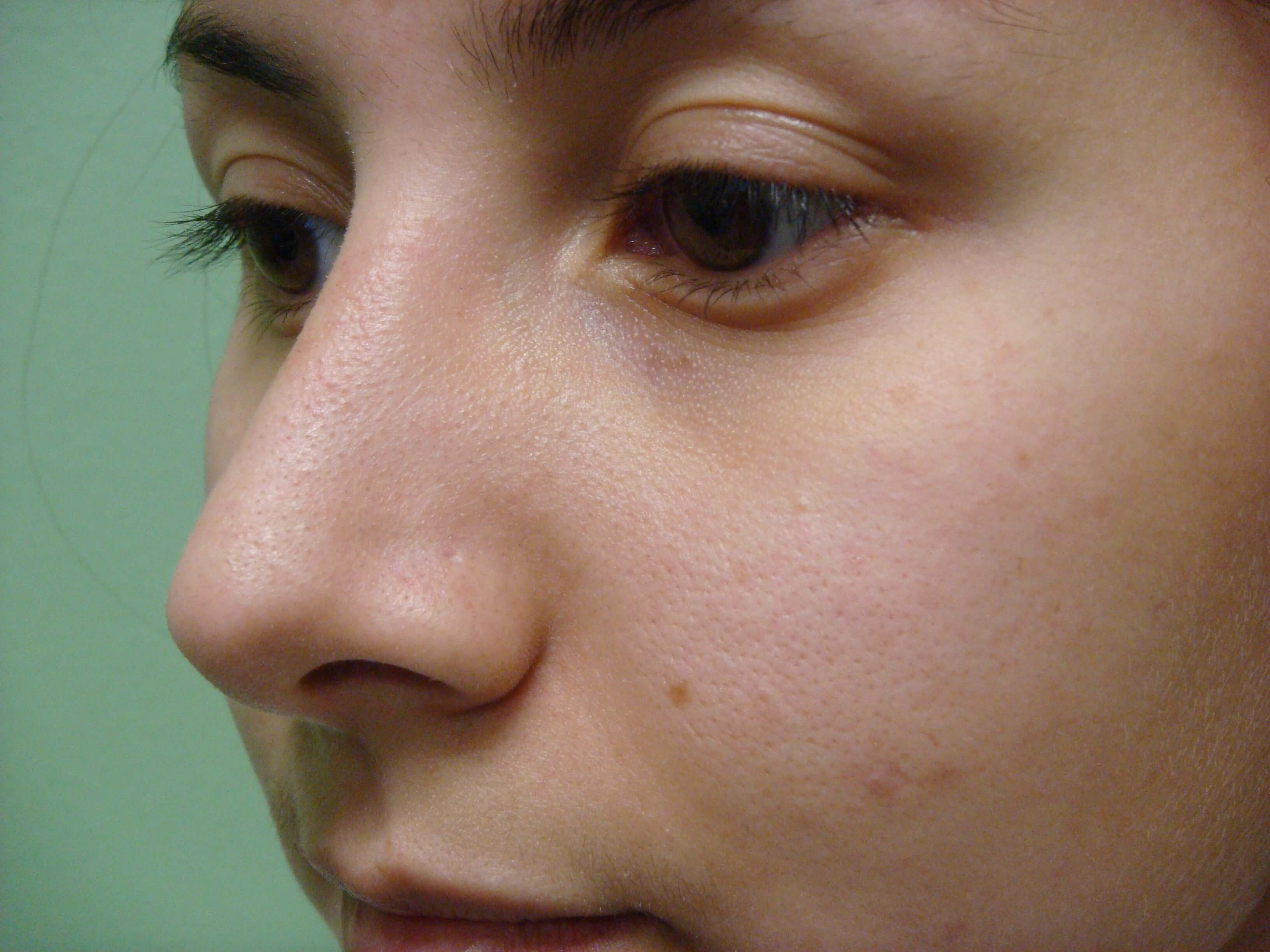 Rhinoplasty (nose job) After