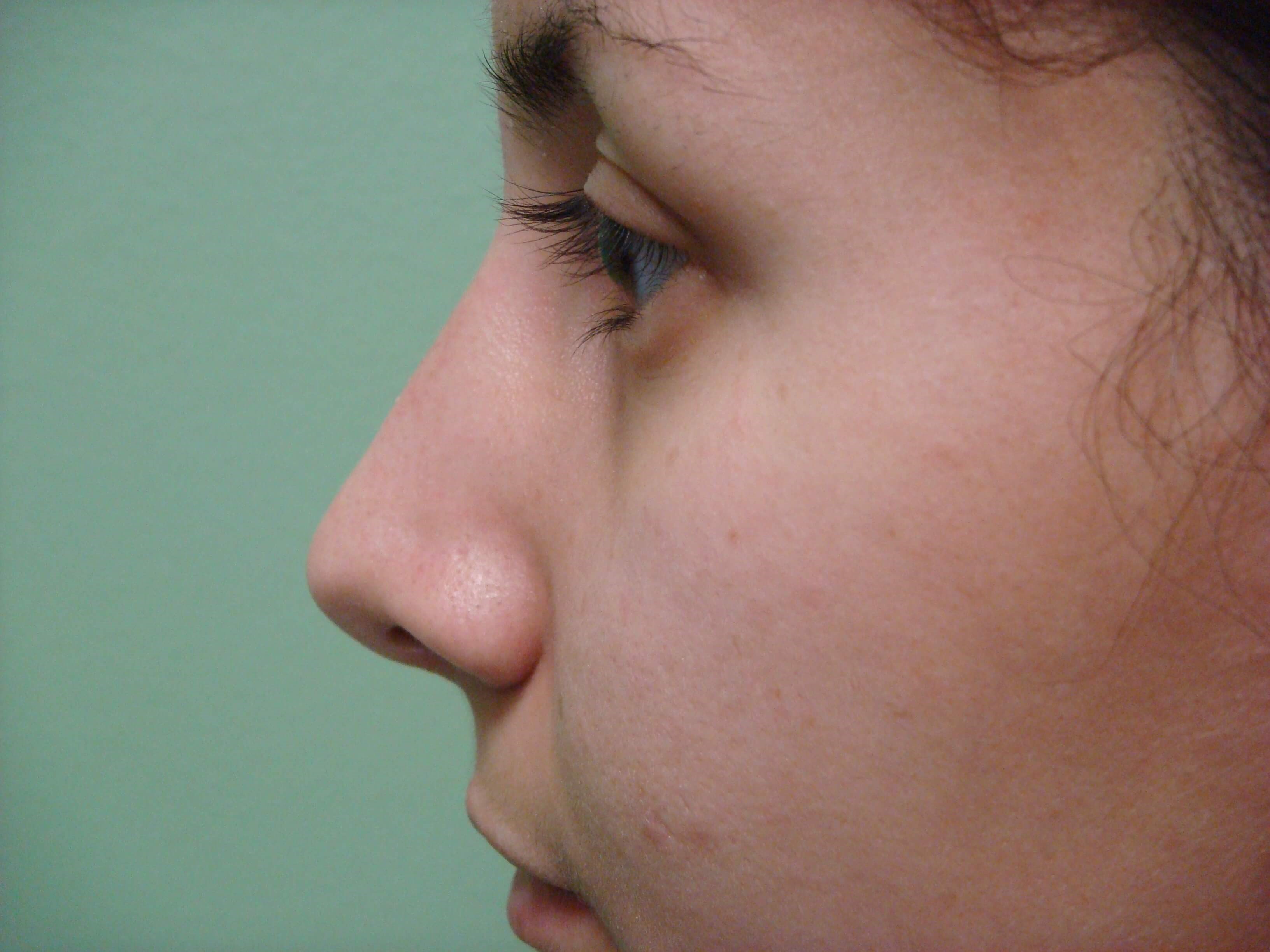Rhinoplasty (nose job) After