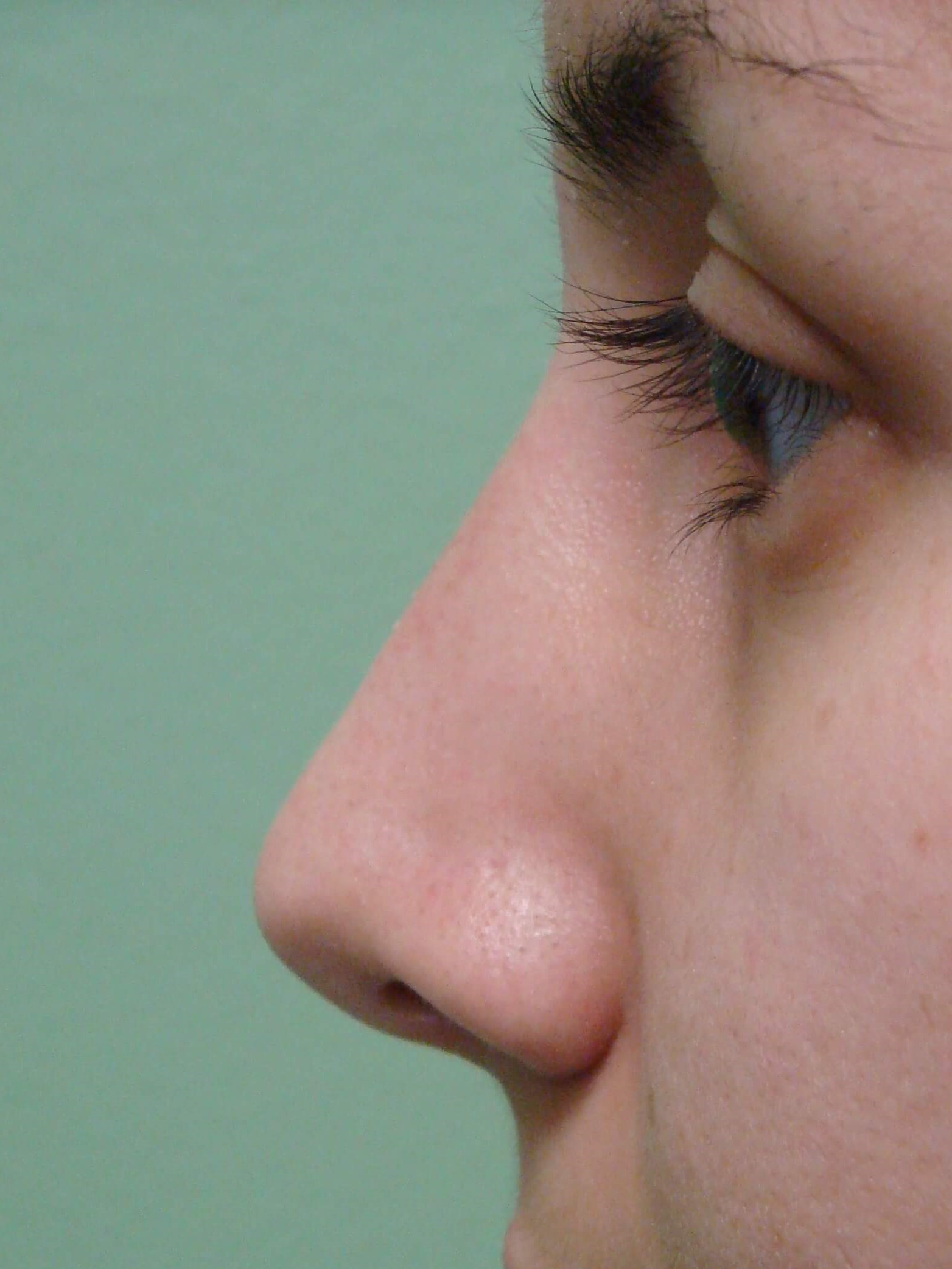 Rhinoplasty (nose job) After