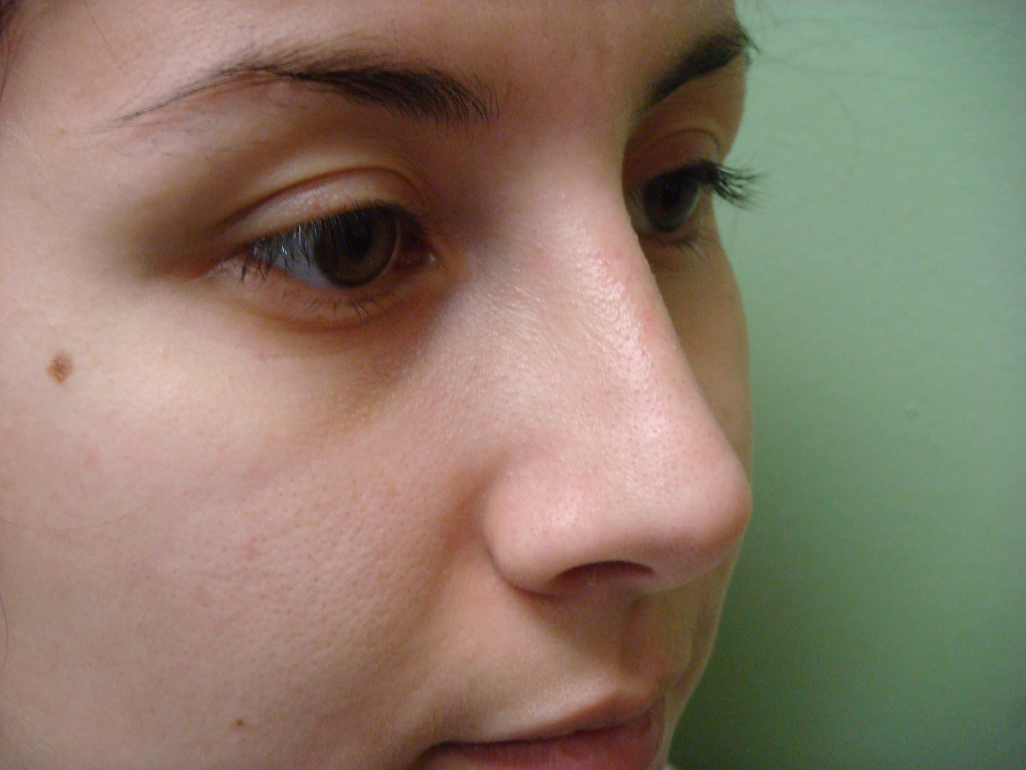Rhinoplasty (nose job) After
