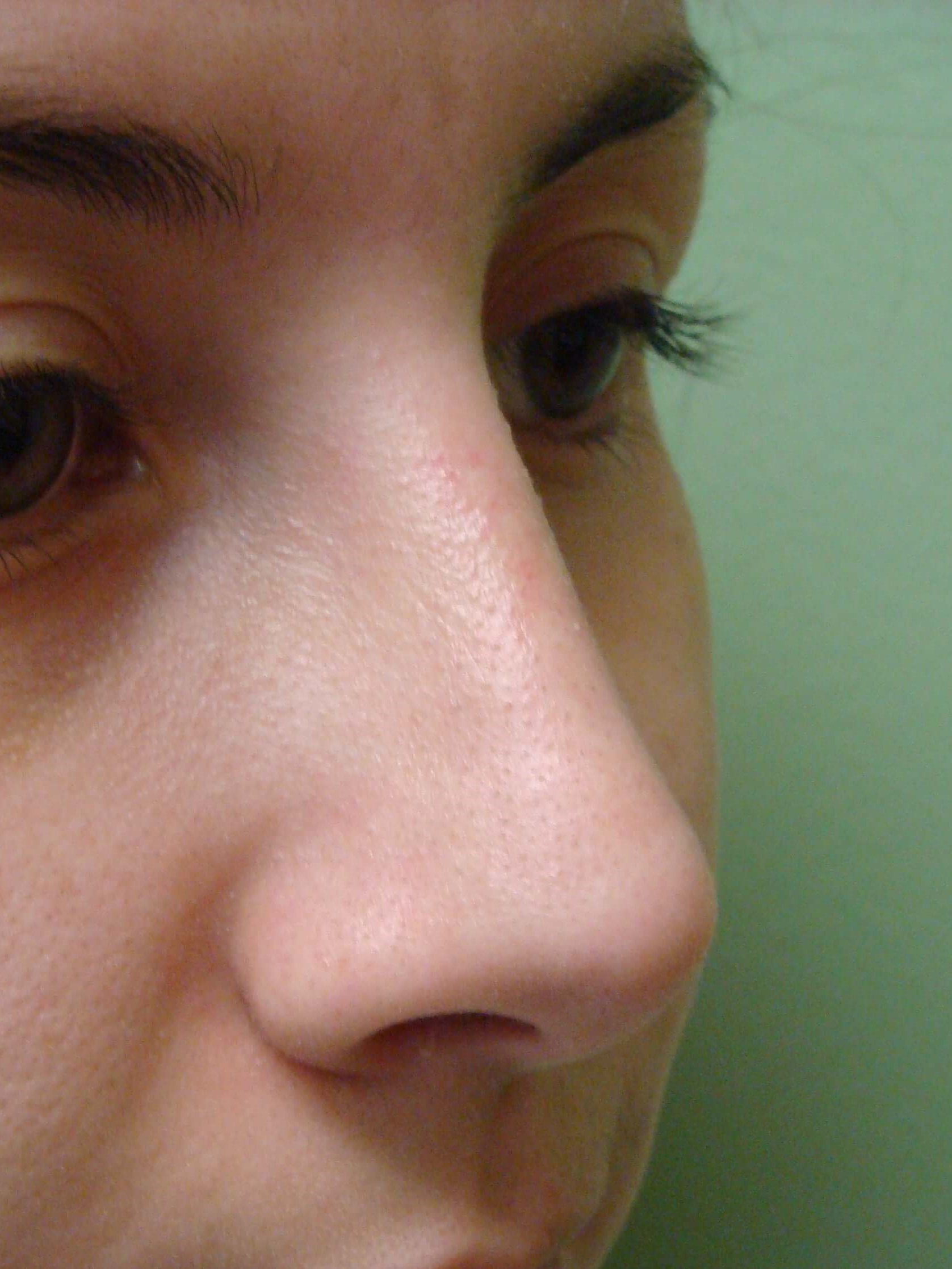 Rhinoplasty (nose job) After