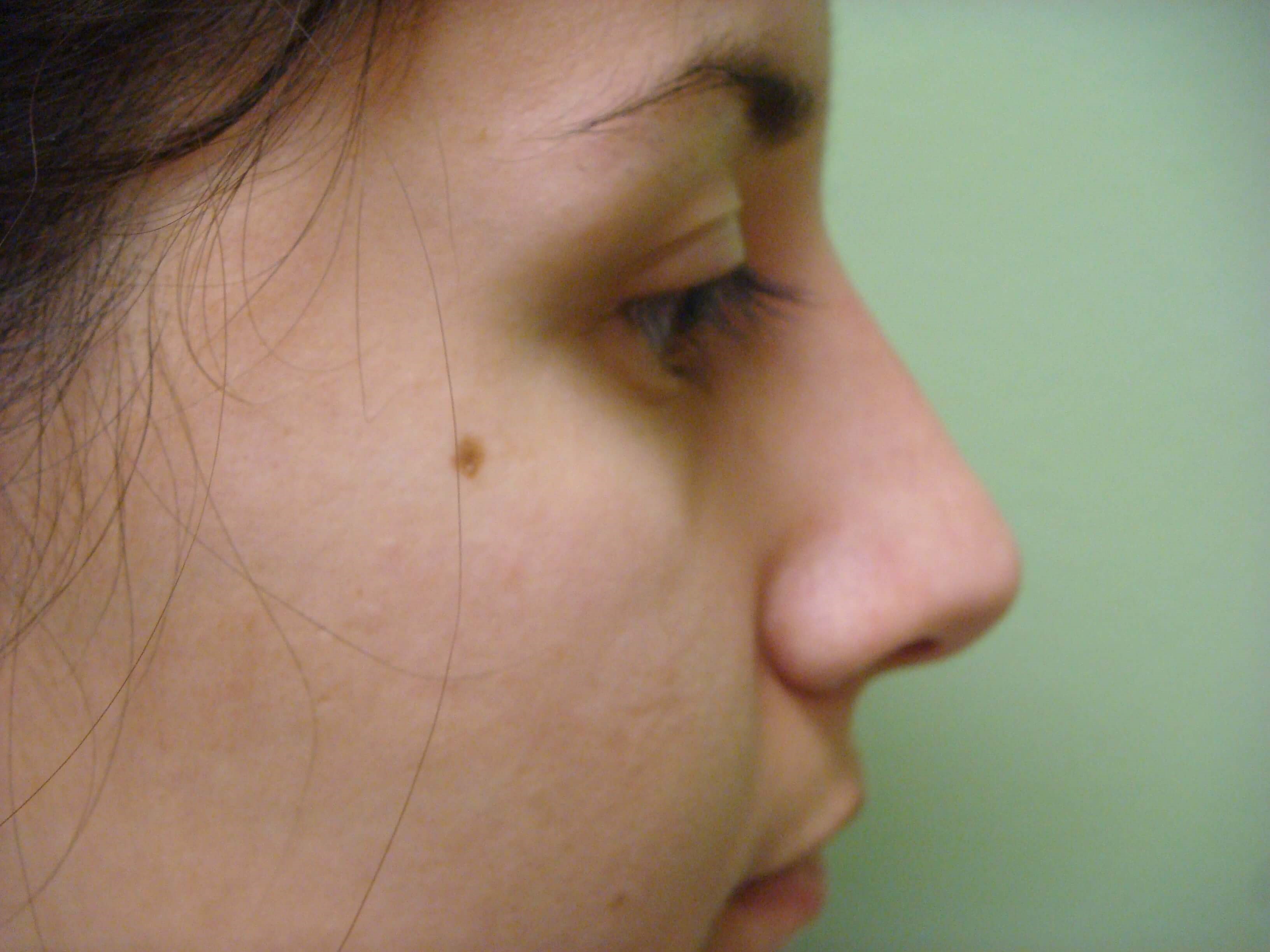Rhinoplasty (nose job) After