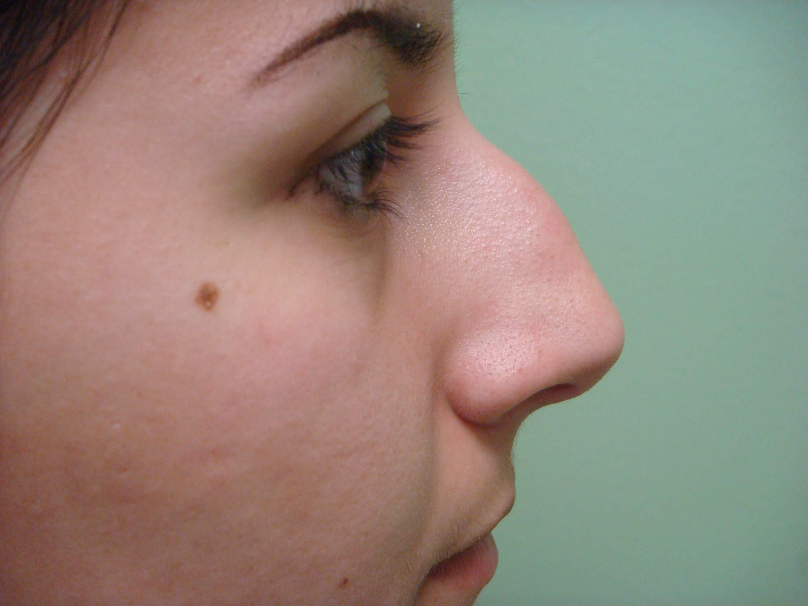 Rhinoplasty (nose job) Before