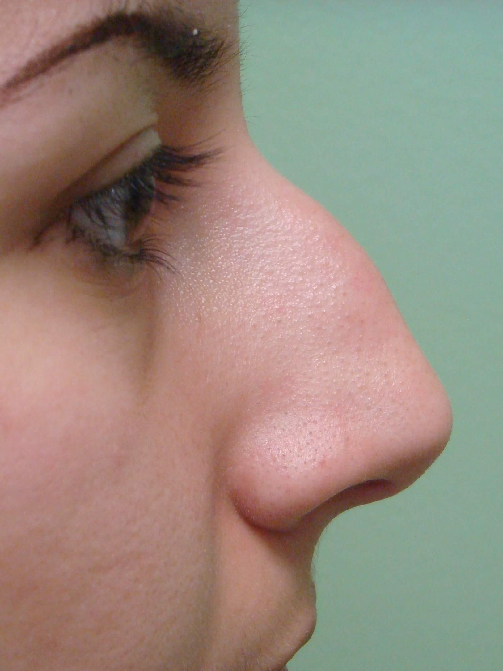 Rhinoplasty (nose job) Before