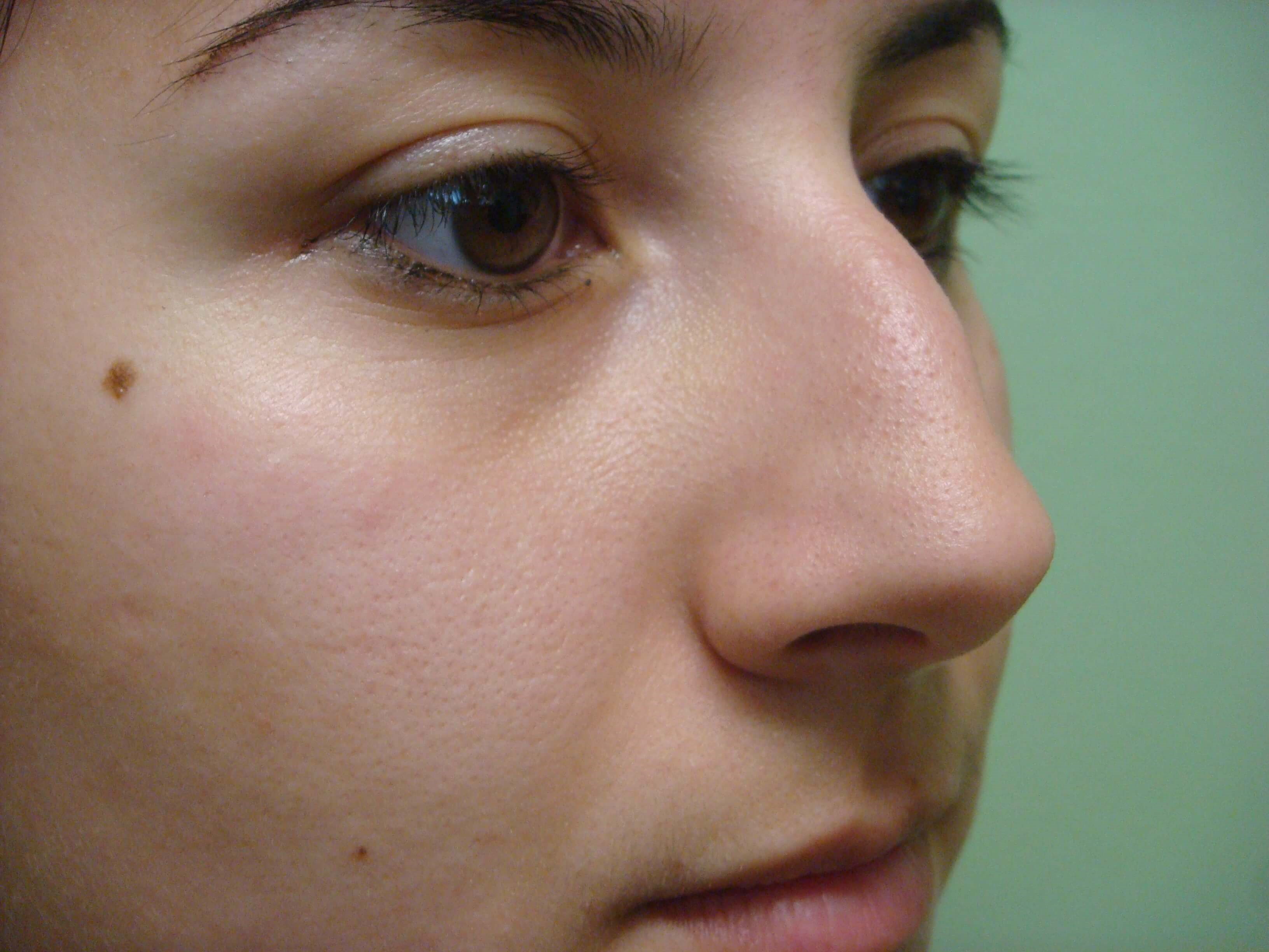 Rhinoplasty (nose job) Before