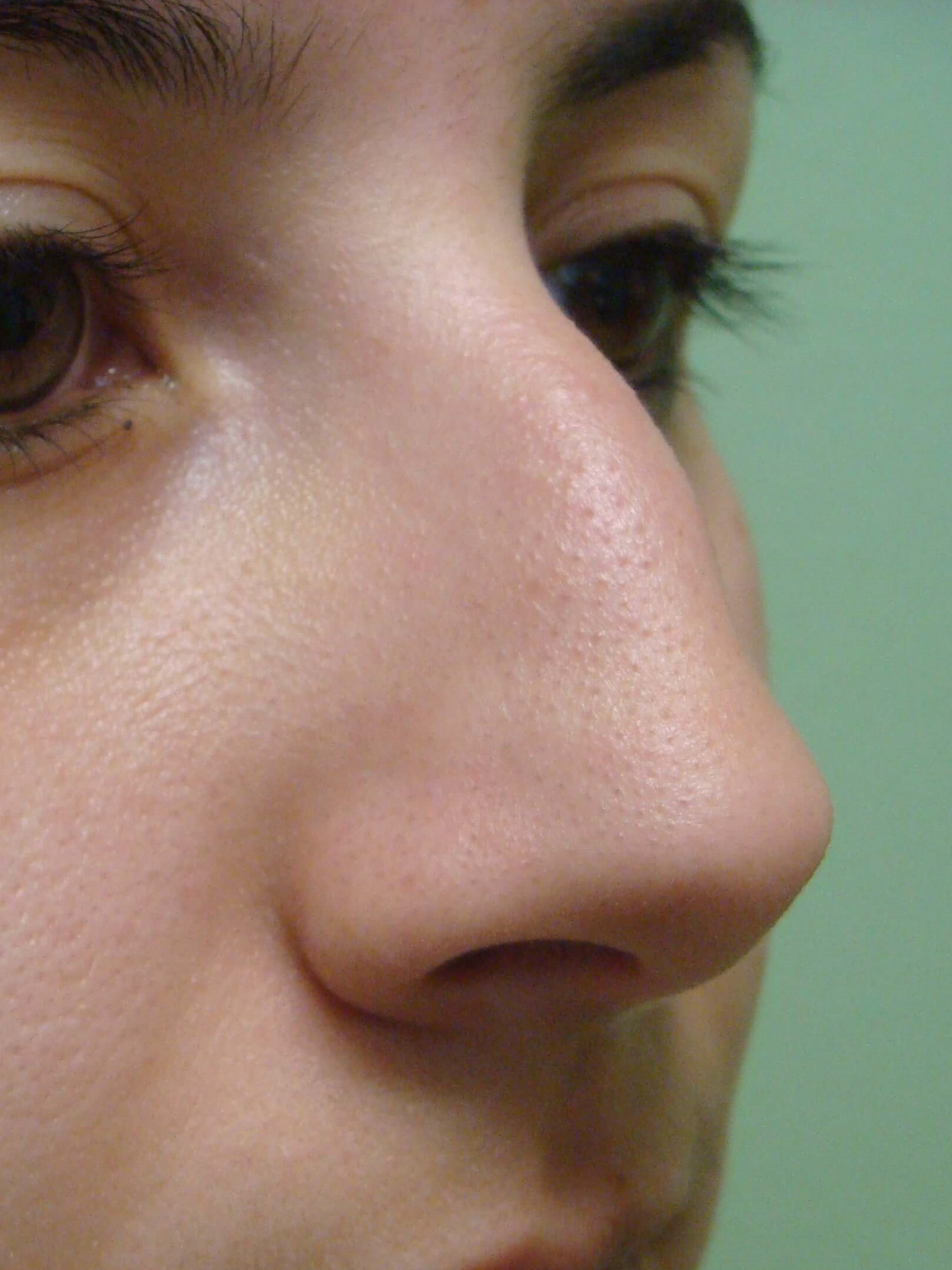 Rhinoplasty (nose job) Before