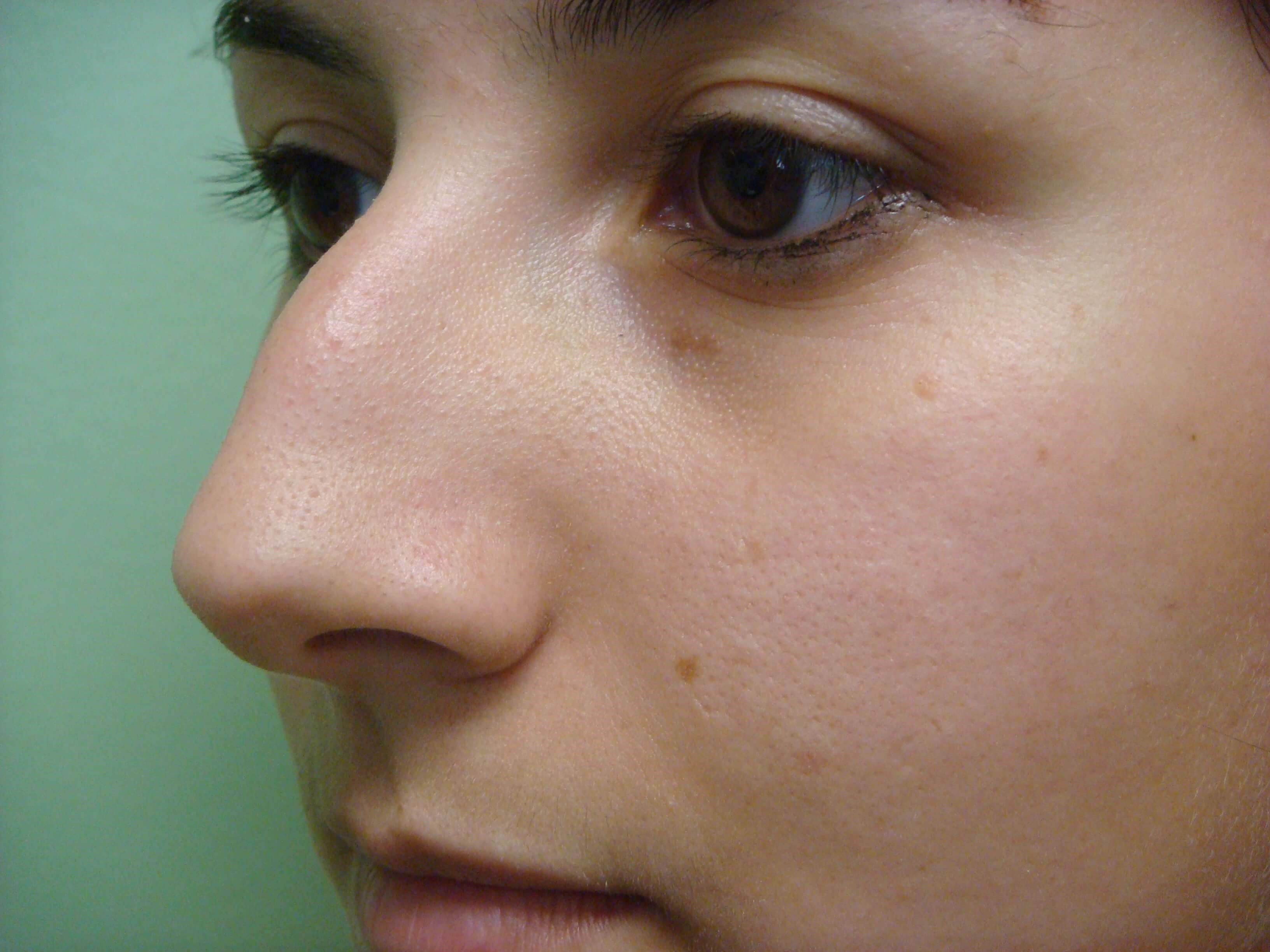 Rhinoplasty (nose job) Before