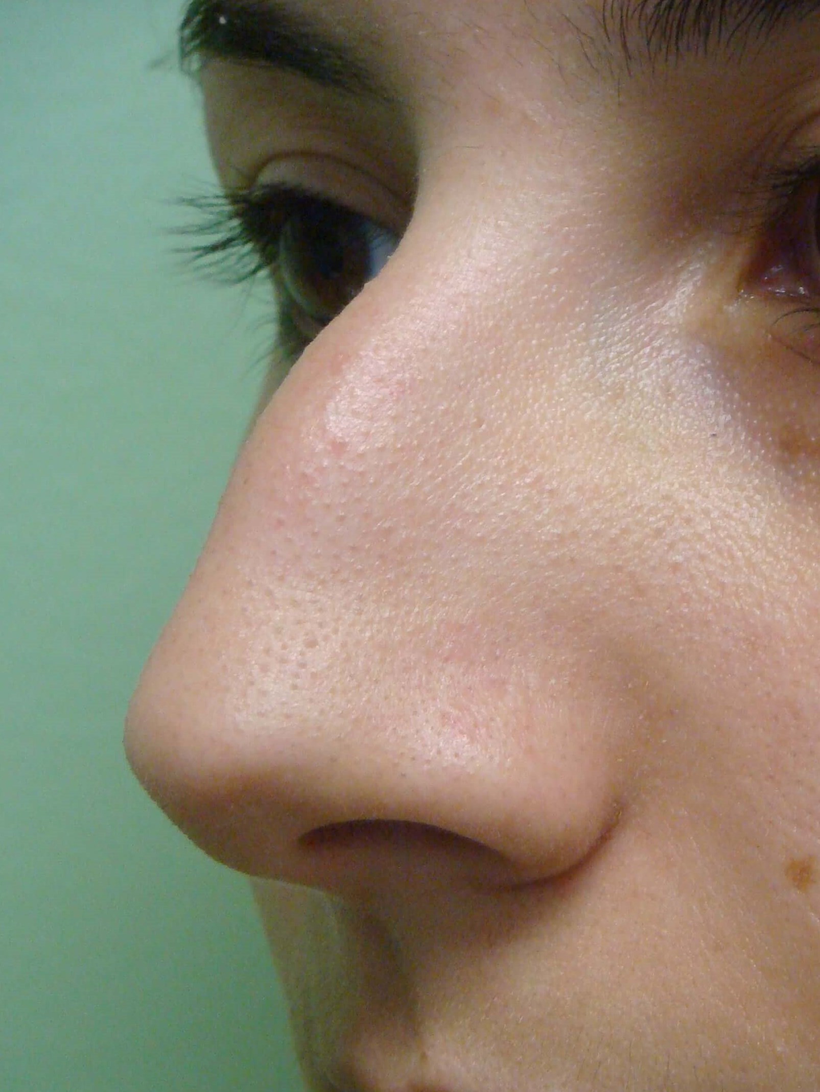 Rhinoplasty (nose job) Before