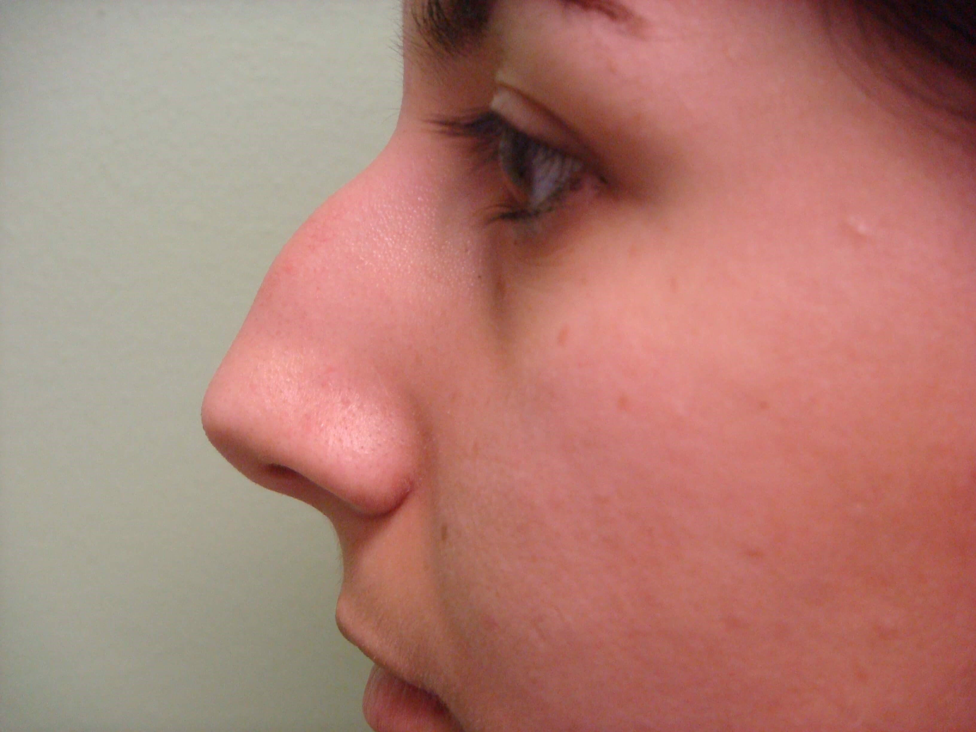 Rhinoplasty (nose job) Before