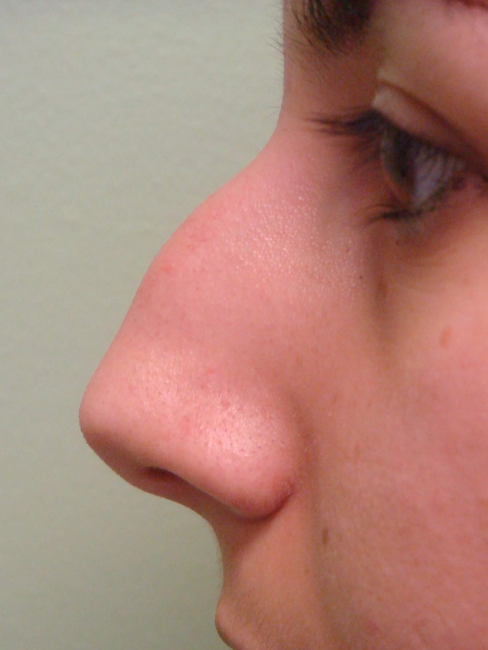 Rhinoplasty (nose job) Before