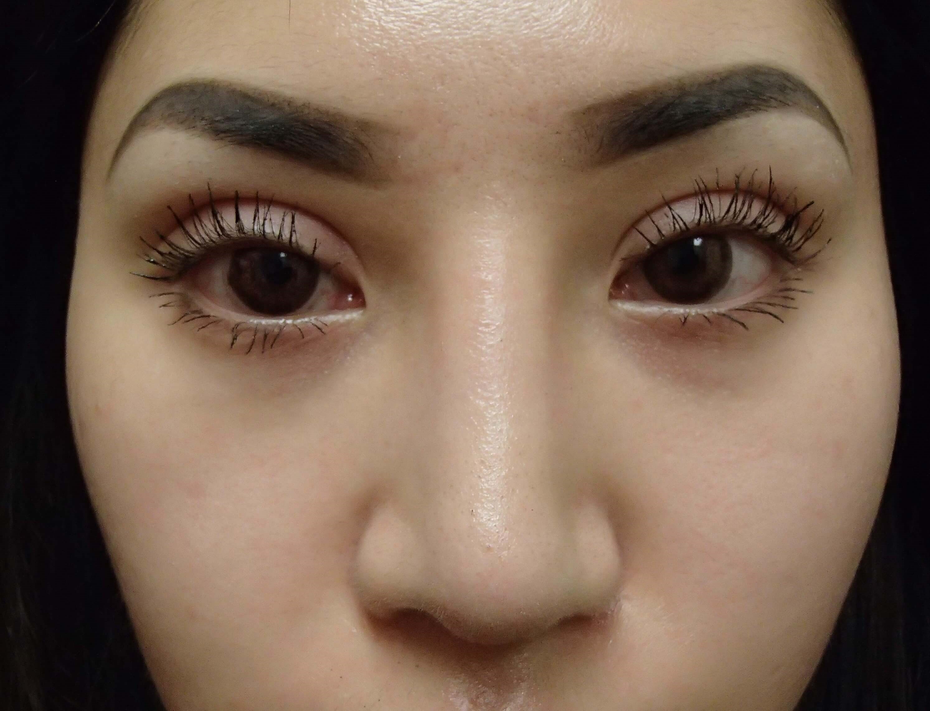 Rhinoplasty and Asian Eyelid After